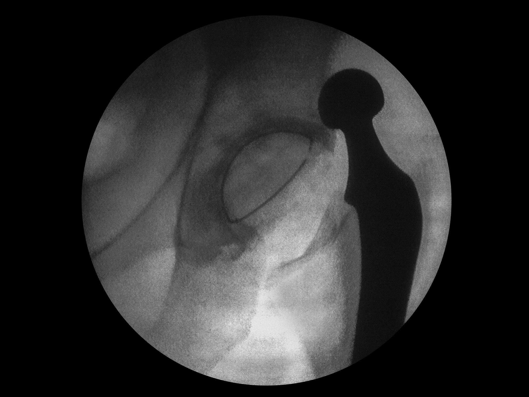 dislocated total hip replacement