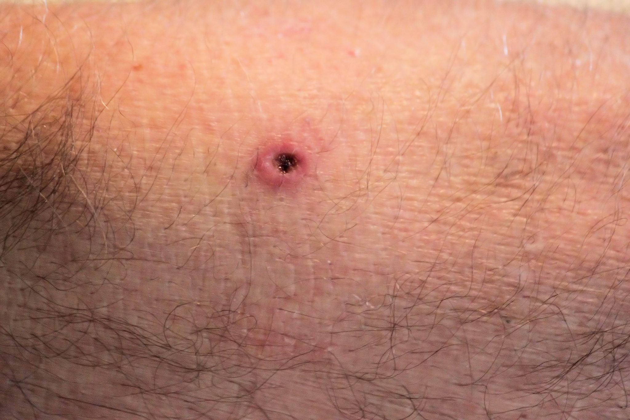 skin cancer test sample removed