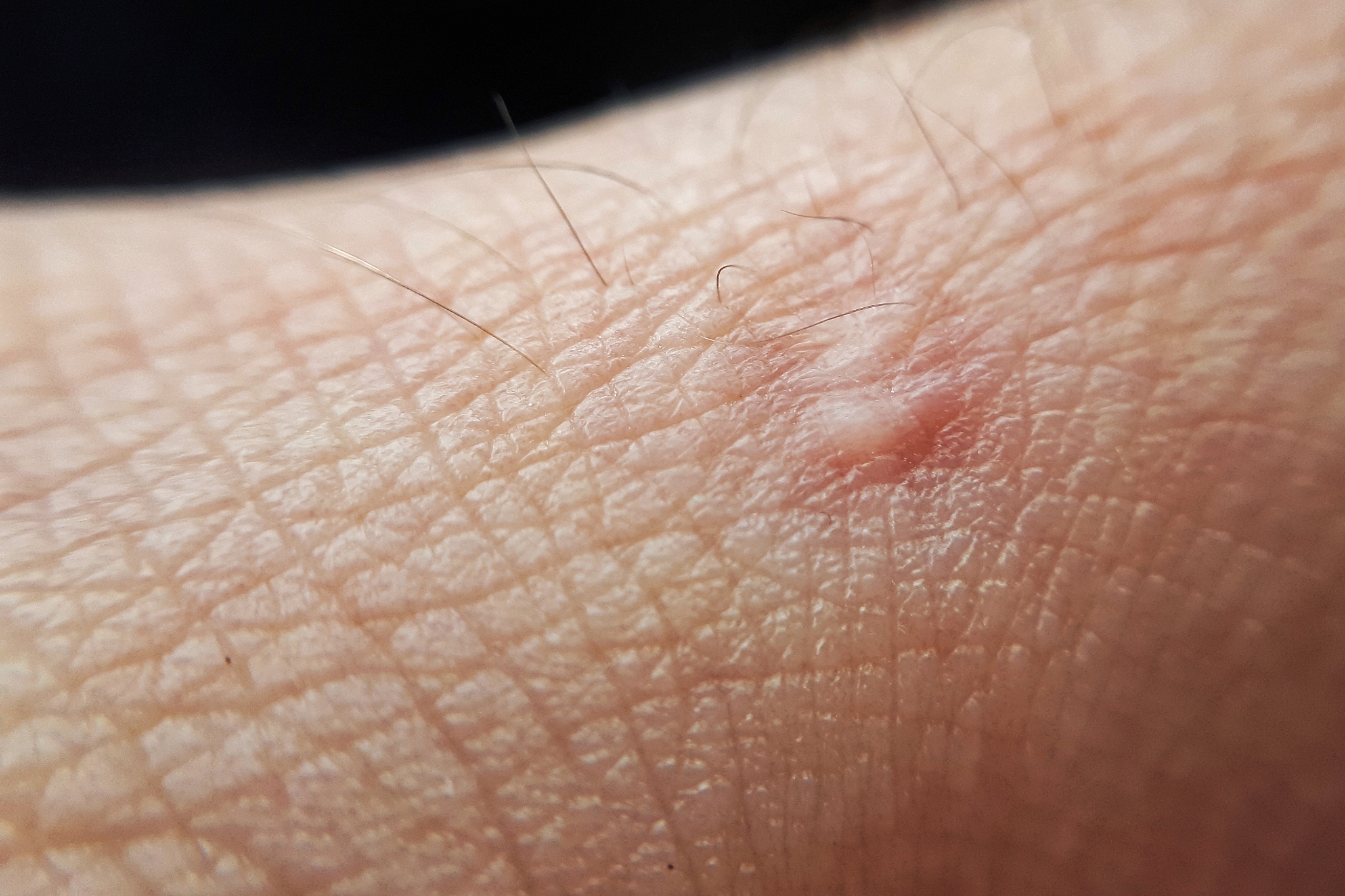 macro scar on human hand. close-up skin texture.