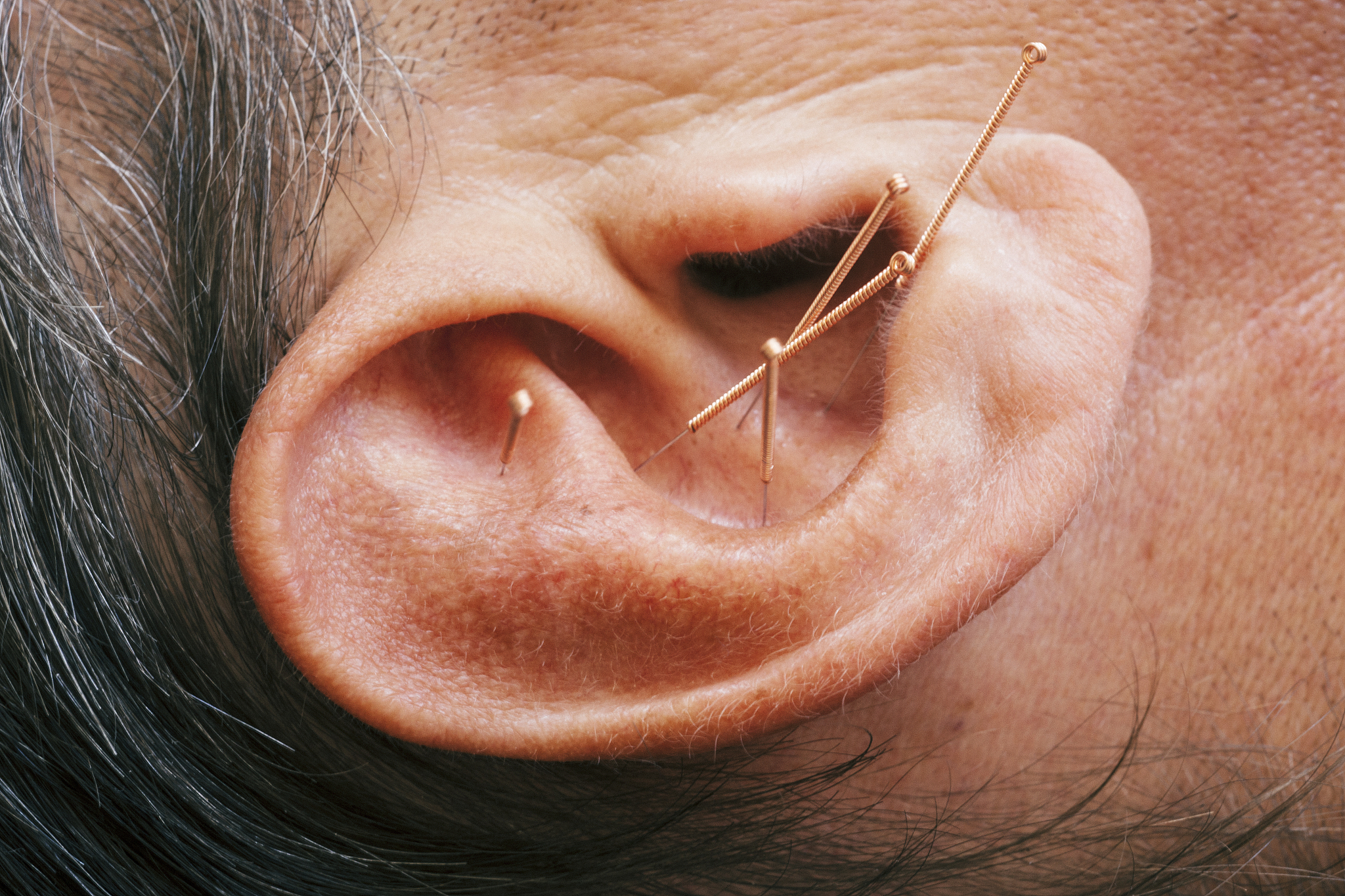 close up of acupuncture needles in a mans ear