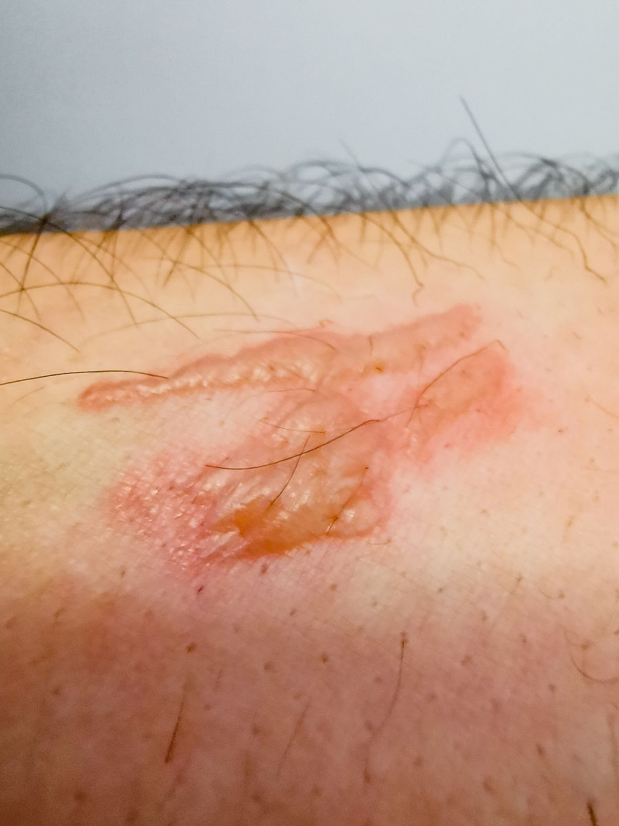 伤口好了后皮肤疤痕皮肤凸起