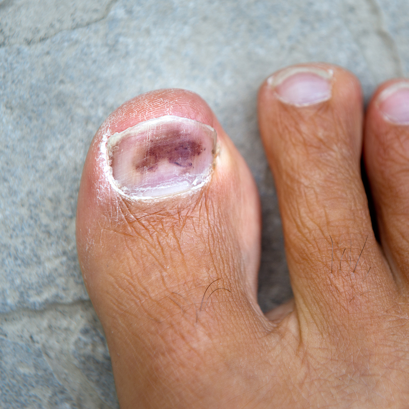 打球导致脚趾甲瘀血变黑怎么修复