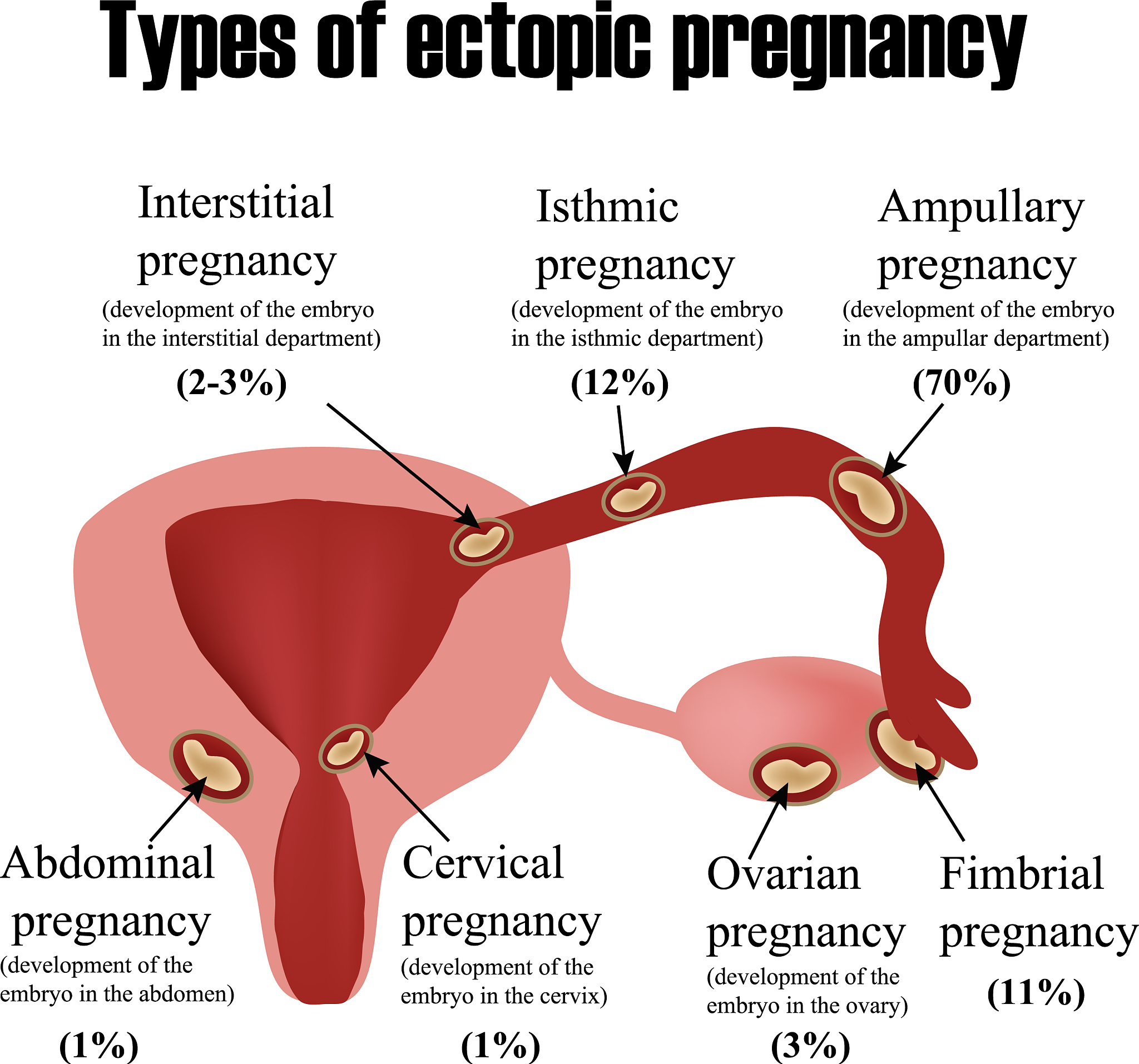 糖尿病患者异位妊娠：风险、症状和治疗