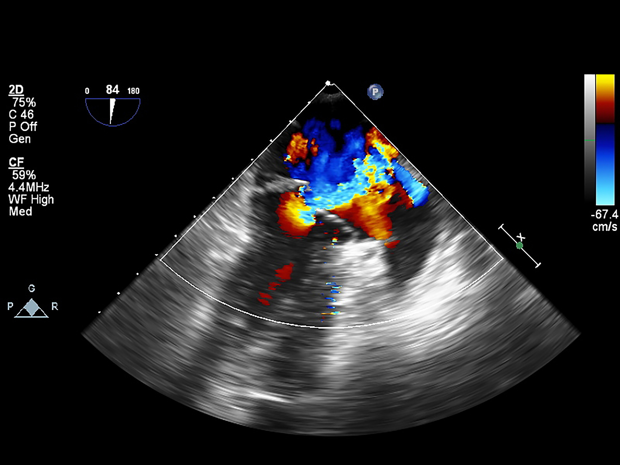血管内超声诊断：导管头显影性及其重要意义
