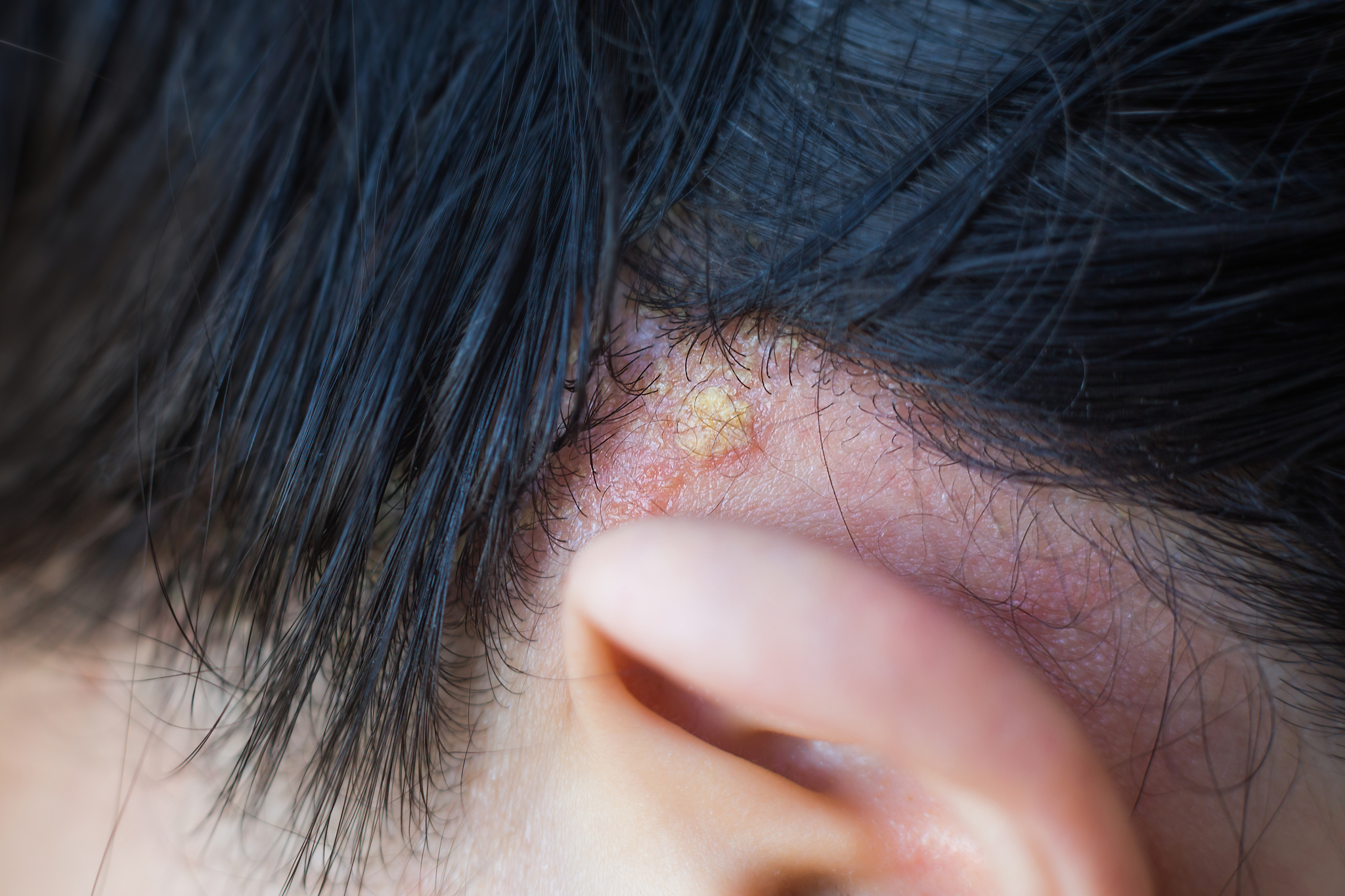 脂溢性皮炎怎么治