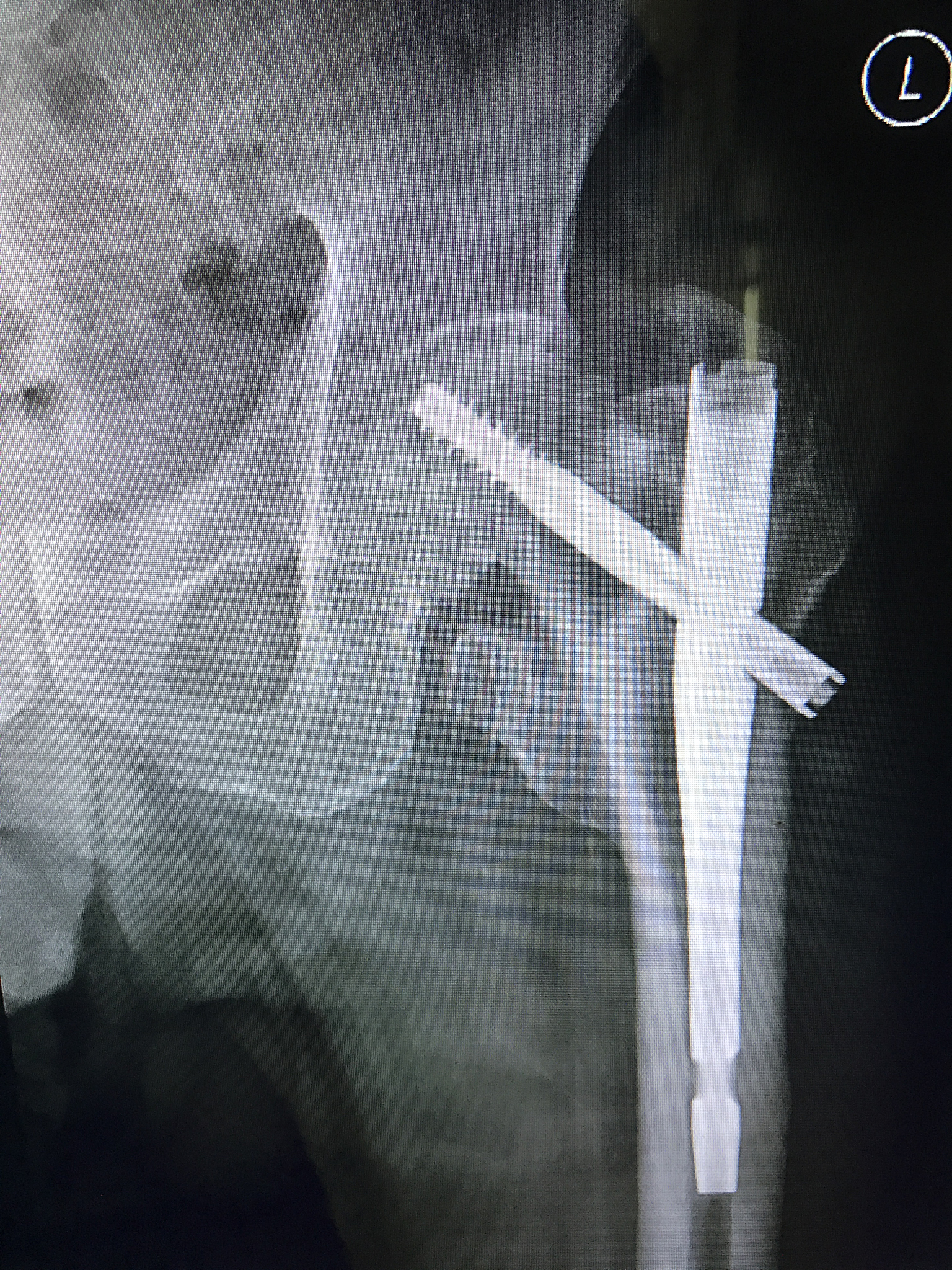 右胫骨平台粉碎性骨折治疗：切开复位内固定术的重要性