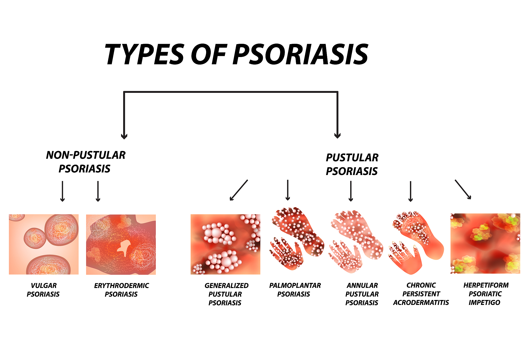 what is Kabuki syndrome