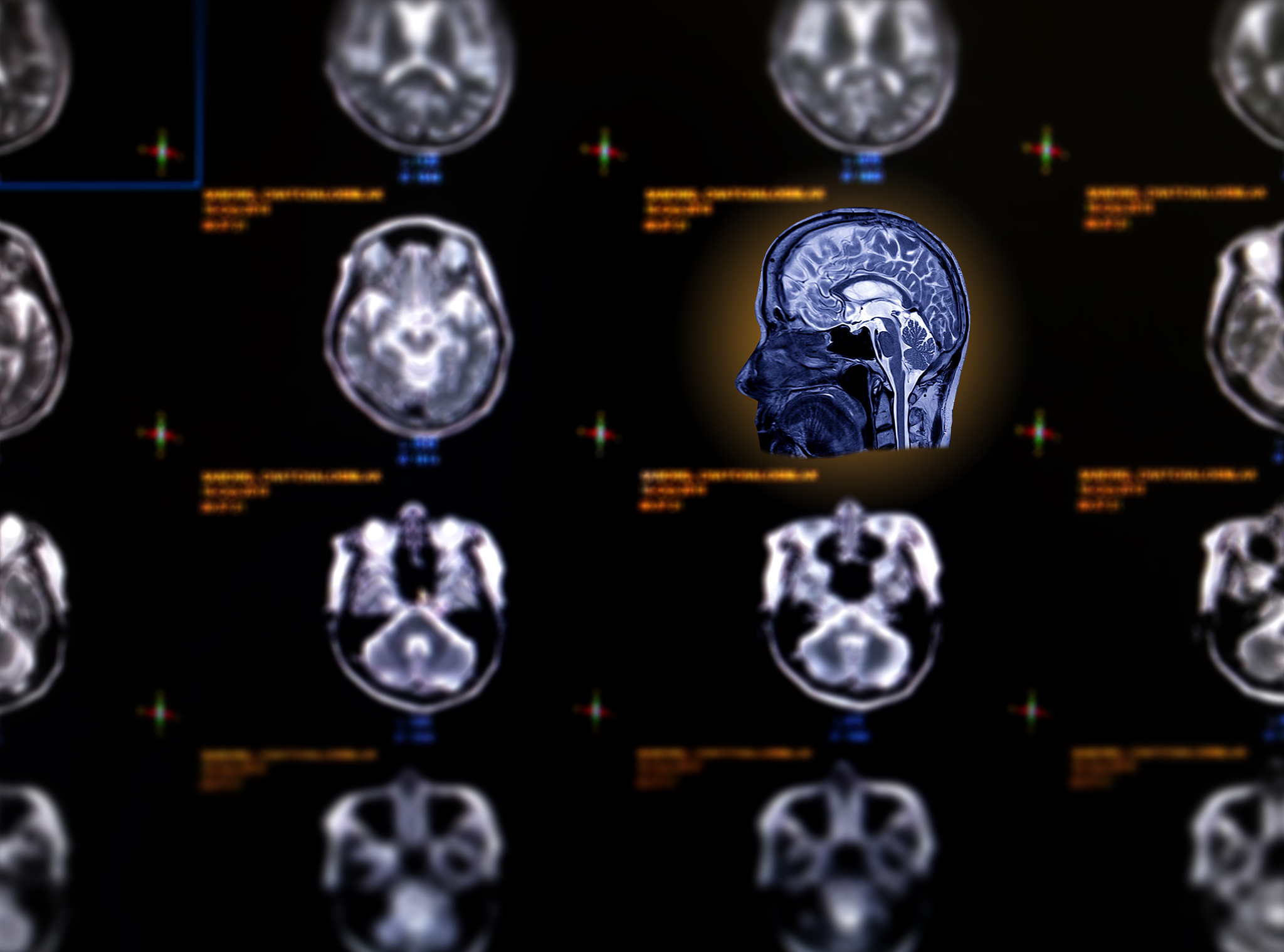 International MICCAI Brainlesion Workshop中文介绍？