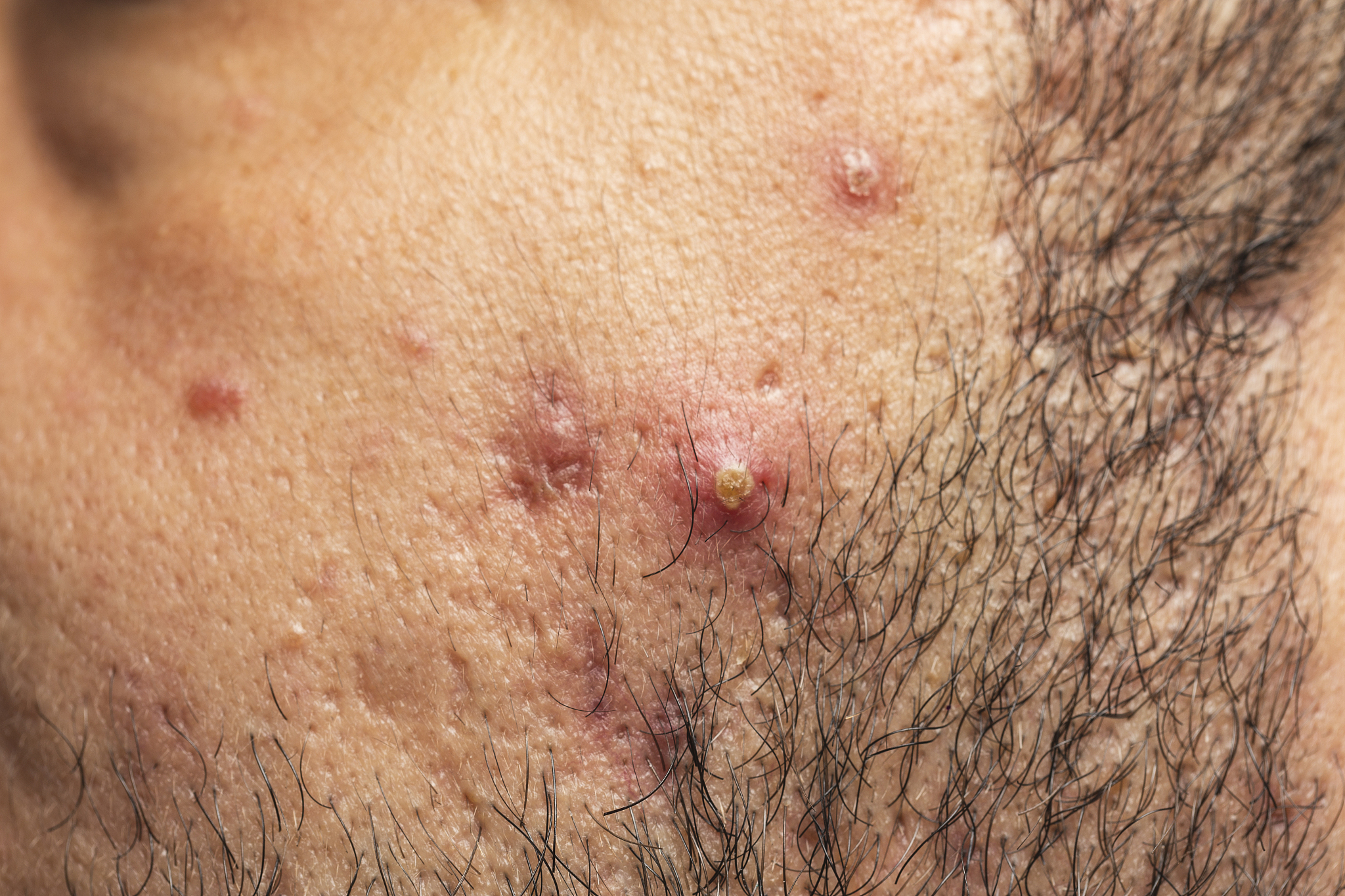 close-up of acne on the skin, acne on the face , wrinkle and acn