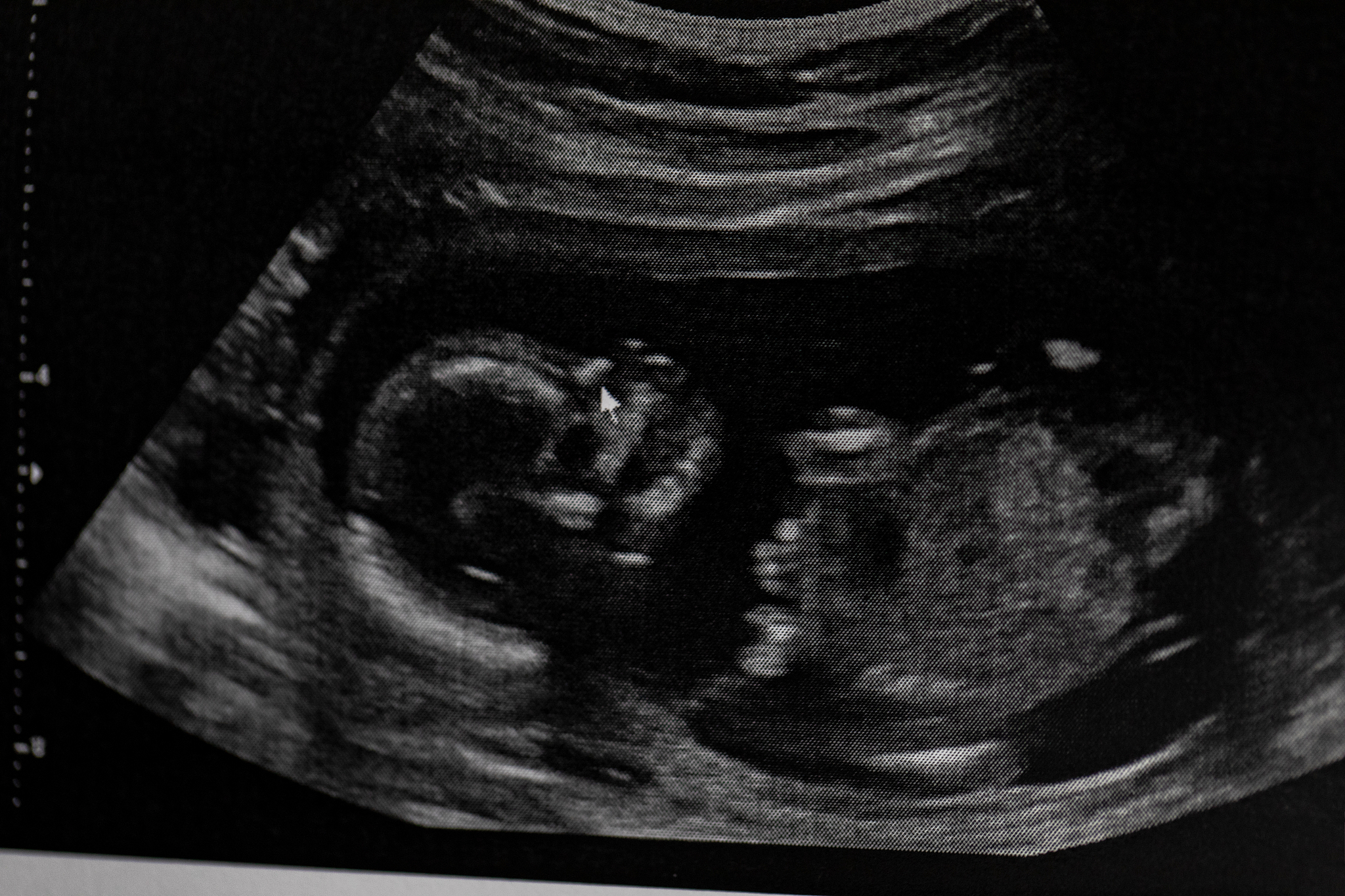 超声造影显示斑块内新生血管，伴局部纤维帽不连续