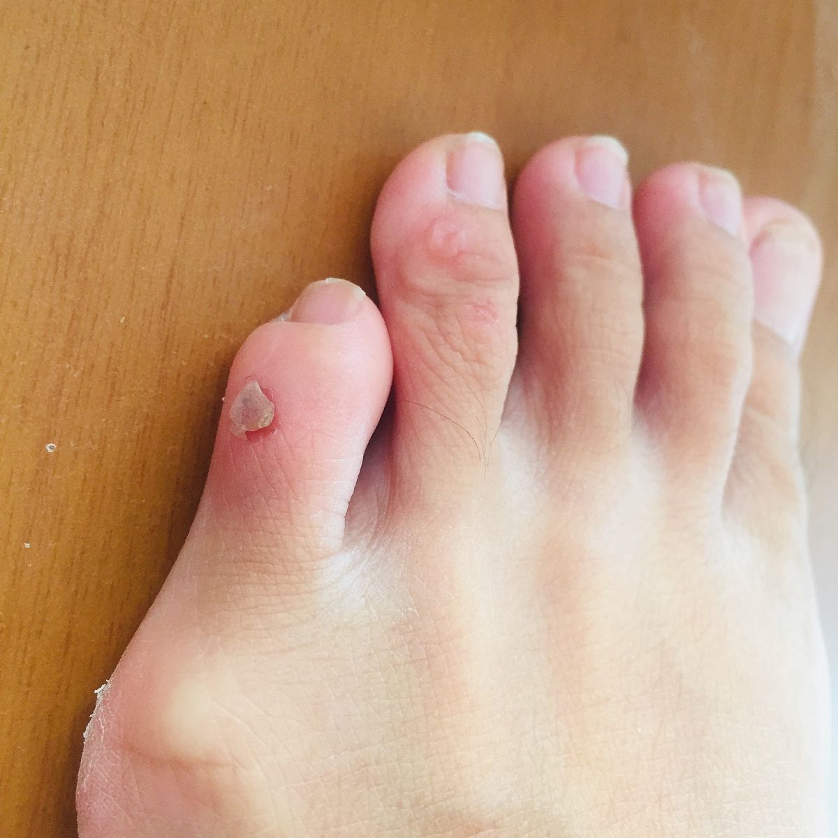 打球脚趾甲瘀血变黑？如何快速修复！