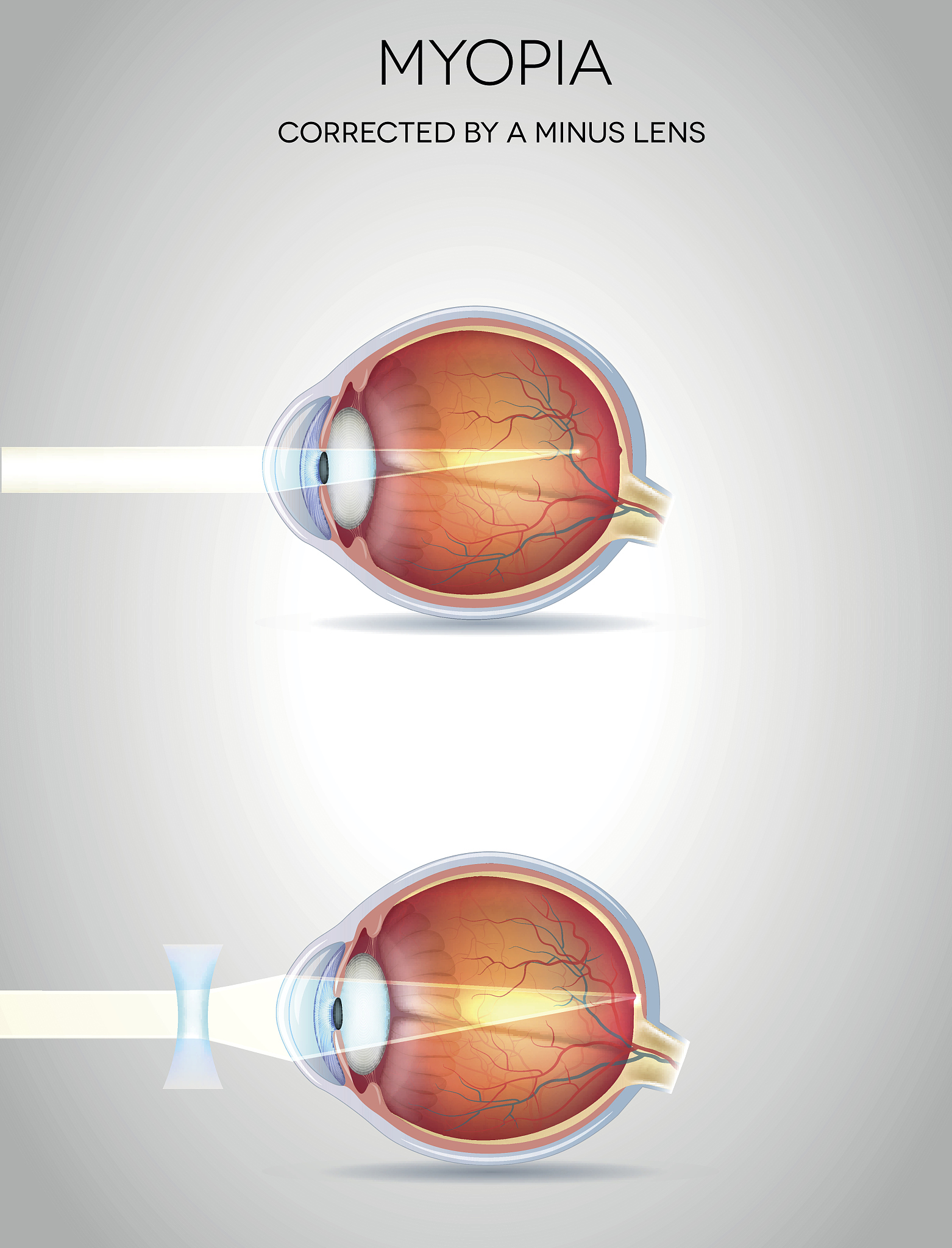 视网膜脱离导致视野受损：能恢复吗？