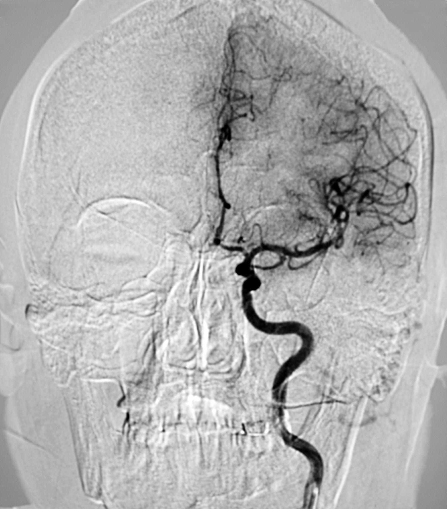右侧颈动脉易损性斑块破裂及血栓形成 - 超声造影检查结果