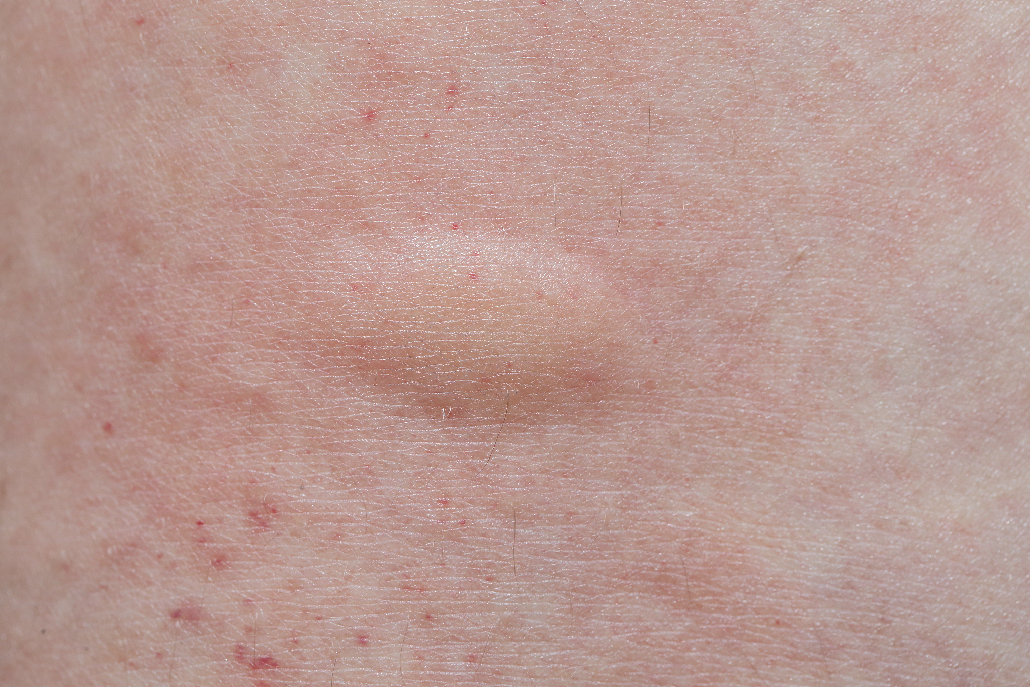 mosquito bites on a leg