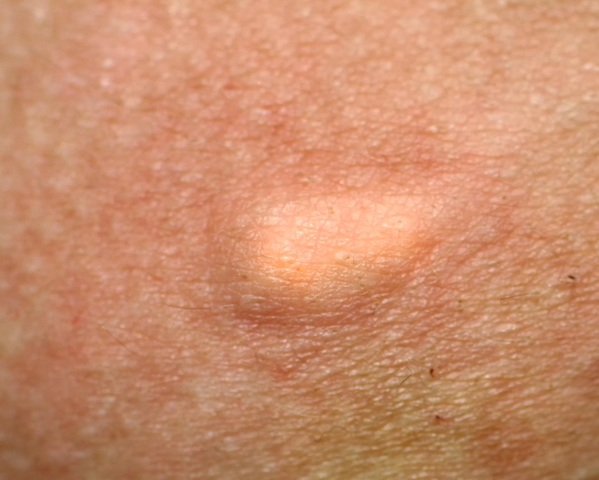 a bite on the skin. tumor on the skin.