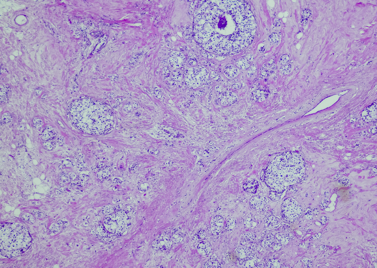 Multi-View Fusion for Early Diagnosis of Breast Cancer with CEM Images: A Joint Approach