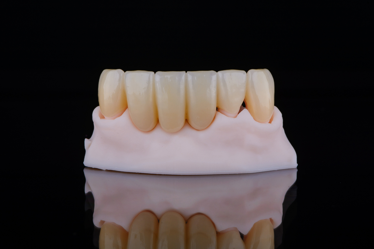 单颌牙列缺损修复方法及效果全面解析