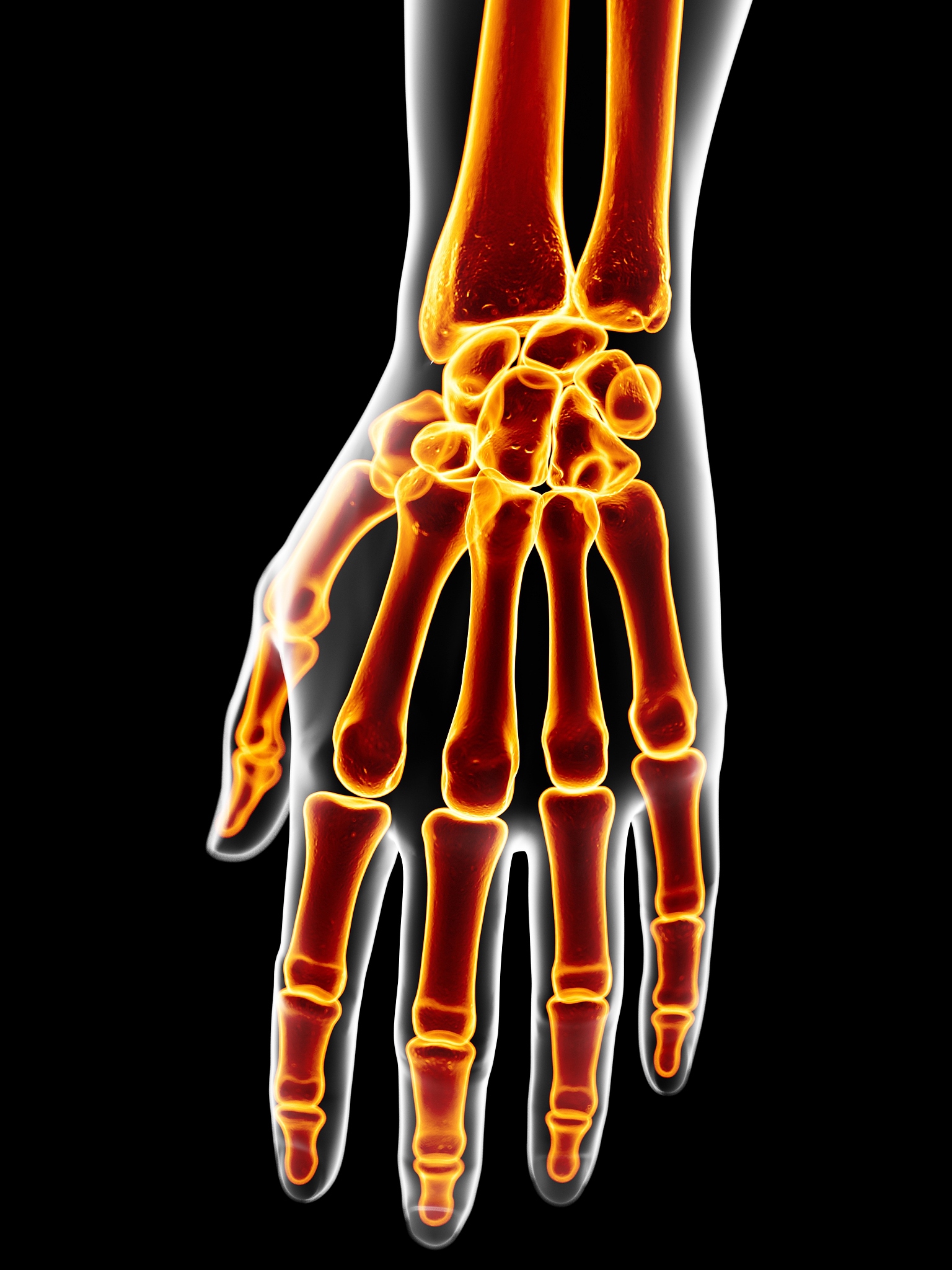 手指康复机械：提升脑卒中患者手部功能的有效工具