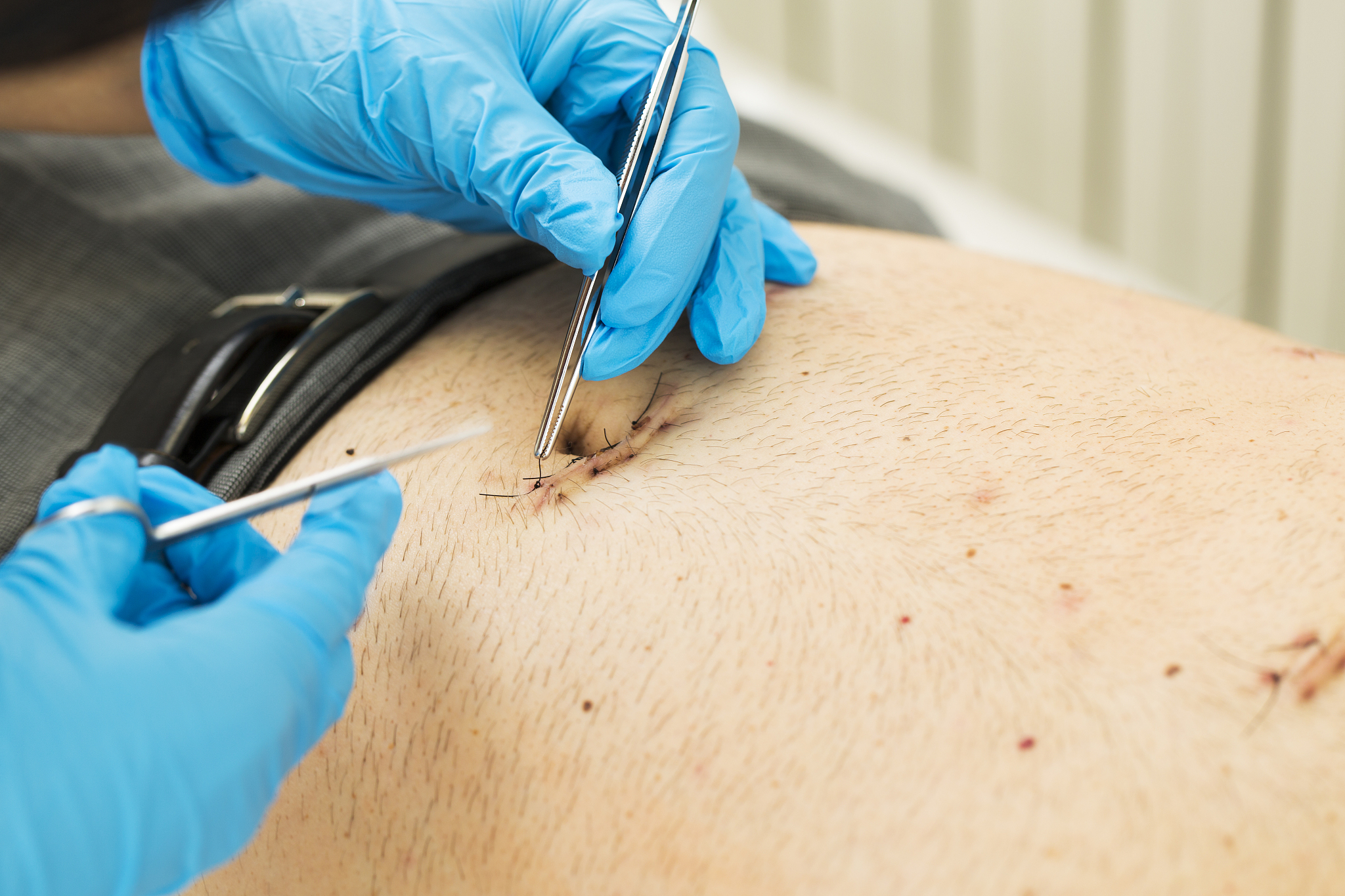 为什么内膜异位会导致疼痛？为什么在月经来潮时疼痛加剧？子宫卵巢全切除手术后多久可以下地活动？为什么？