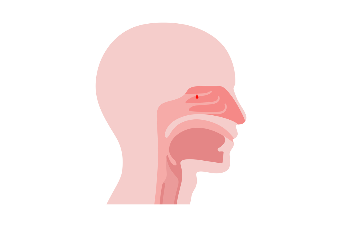 慢性鼻窦炎导致嗅觉障碍的发病机制及临床表现