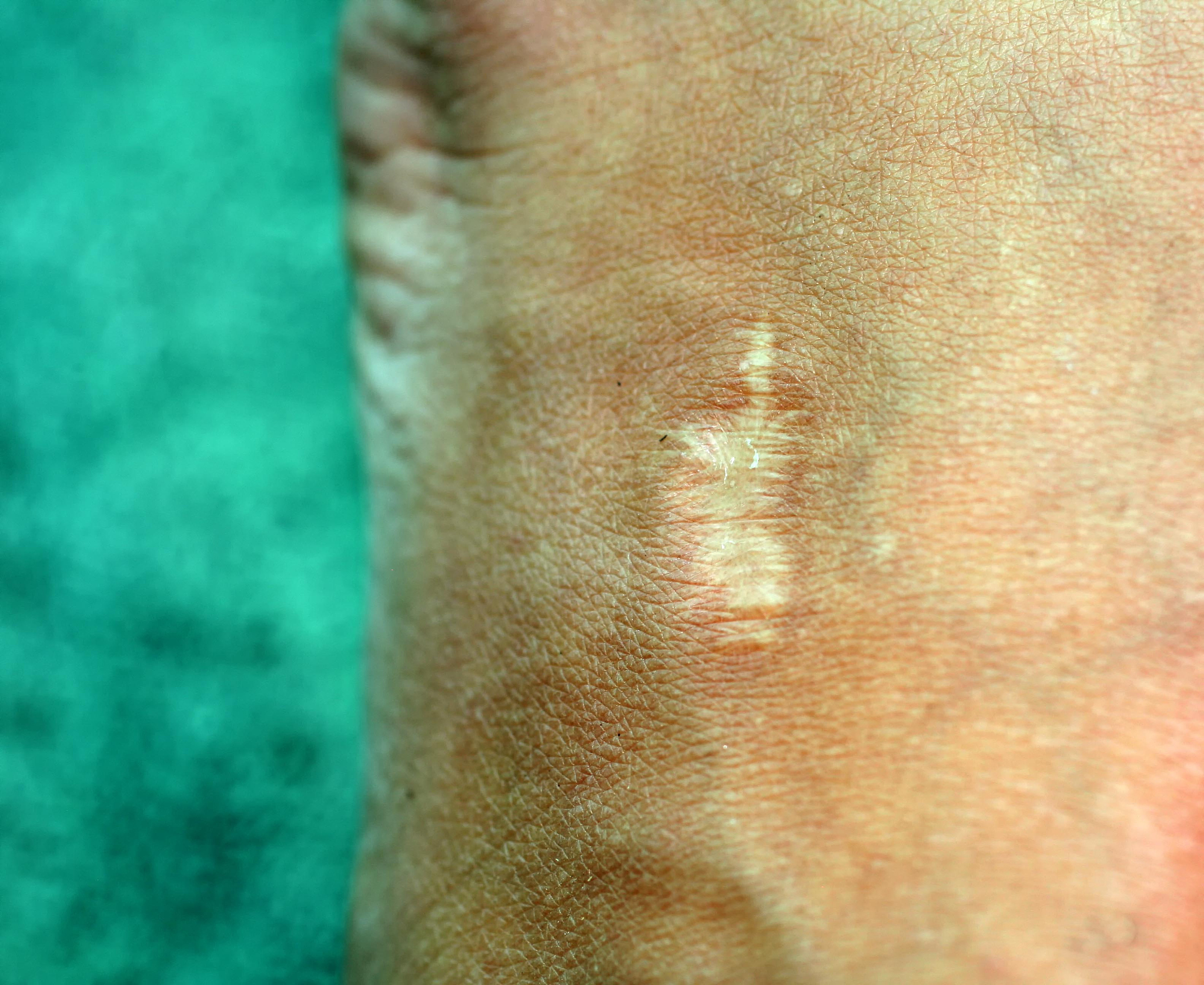 皮肤变硬的原因：疤痕、感染、疾病等，如何判断？