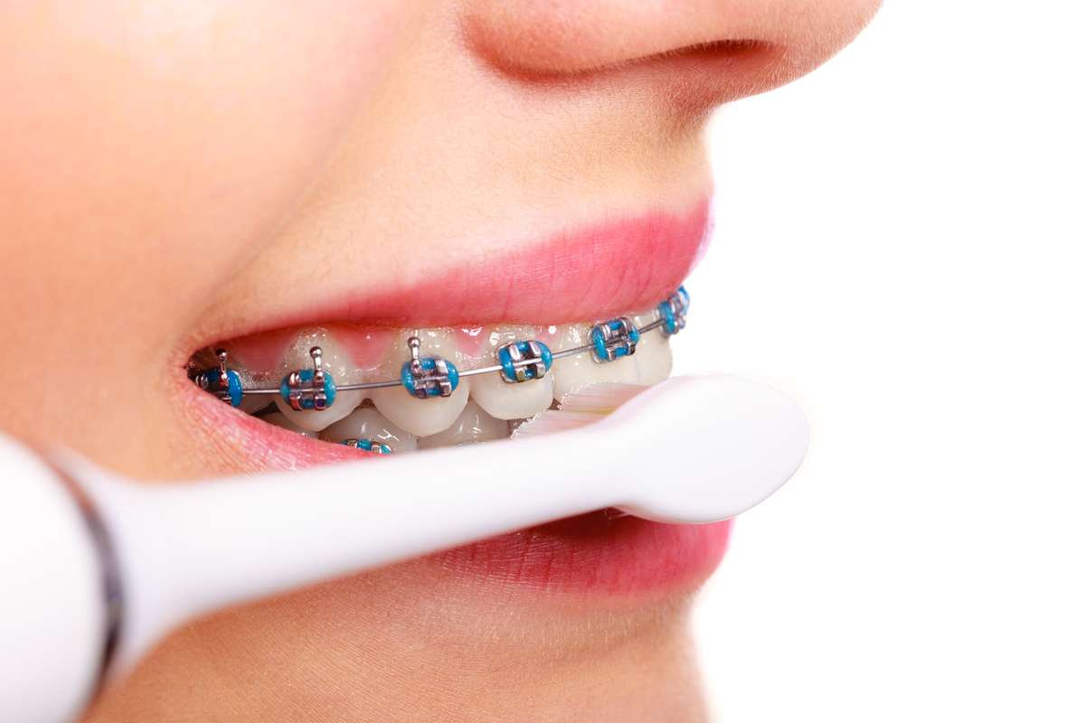 牙齿矫正可以只矫正门牙吗为主题写一篇相关的文章和写一个相关标题