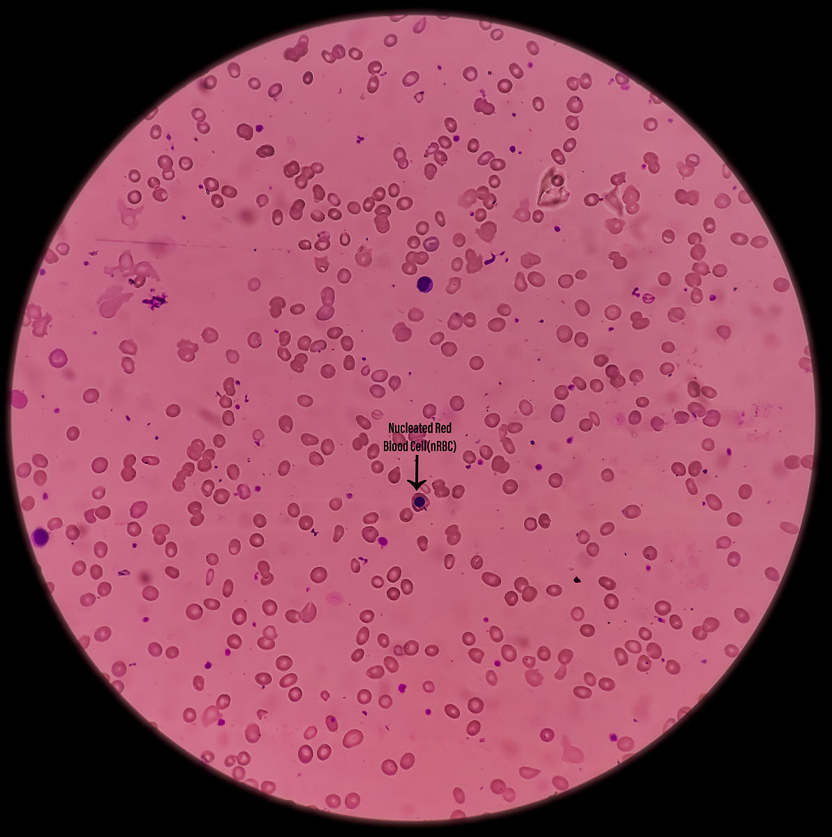 血小板计数为43810^9L血小板积压039血小板体积分布宽度为92其他血常规项目值正常会是什么病症？