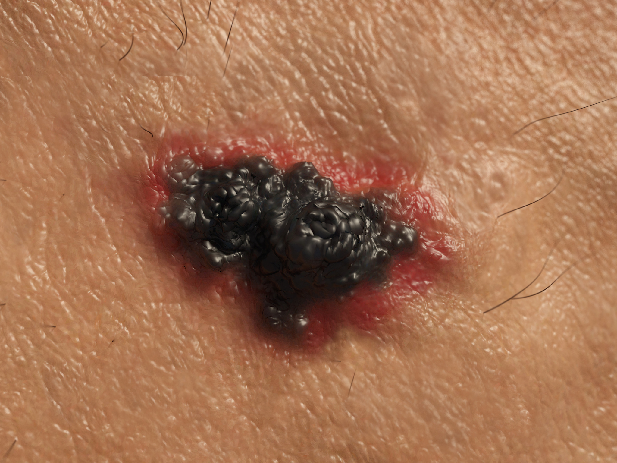 skin cancer