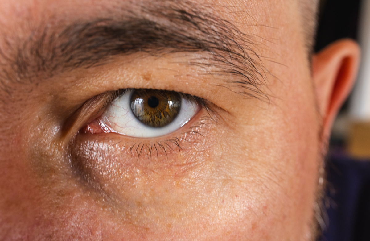 眼前一黑：原因、症状及治疗