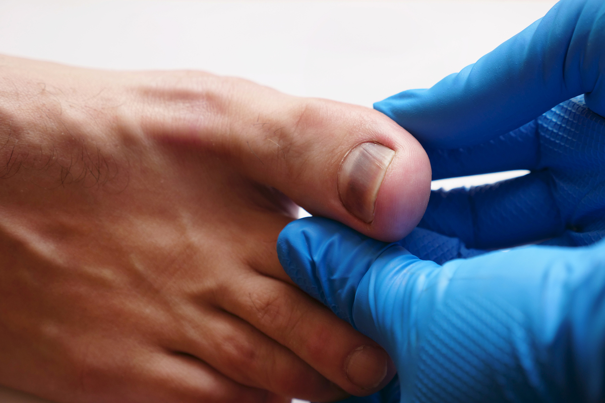 脚指甲掉了可以踢球吗