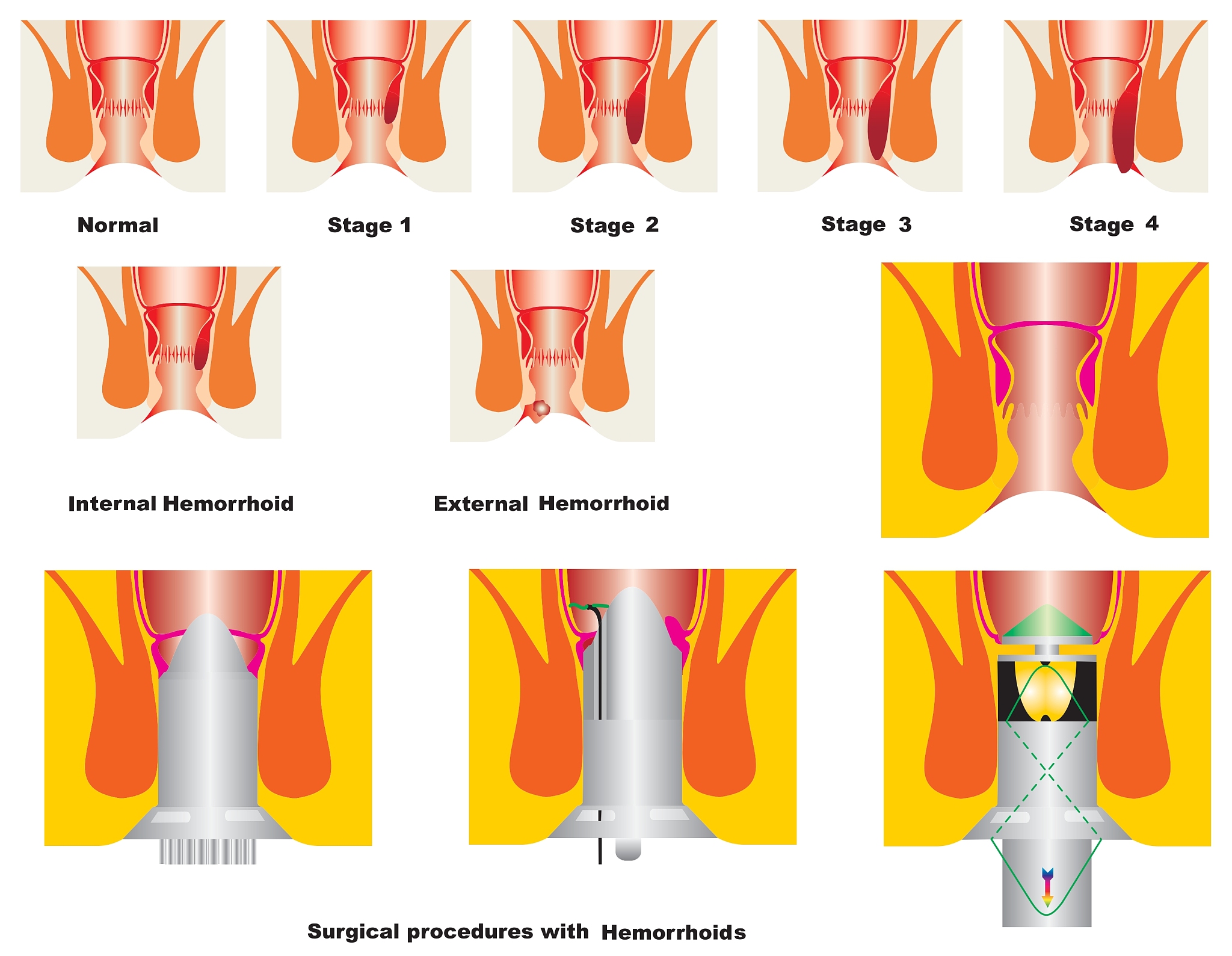 hemorrhoid