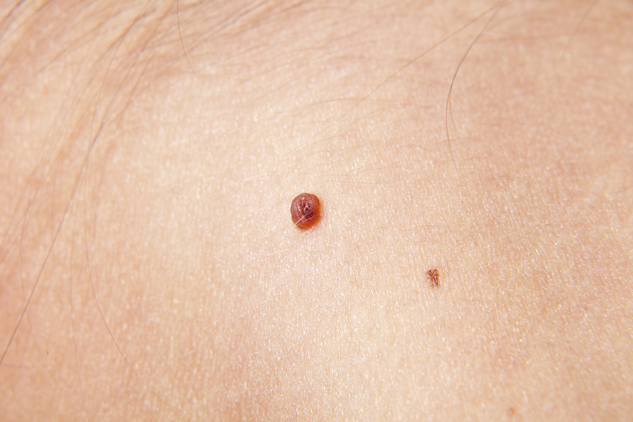 skin cancer xxxl