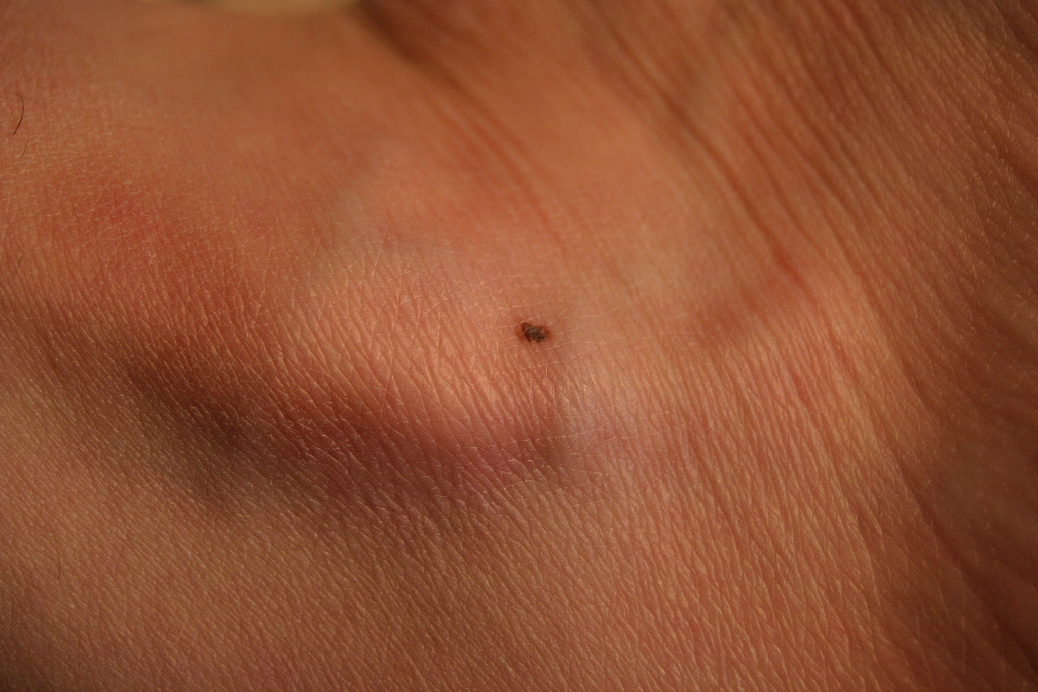 malignant mole