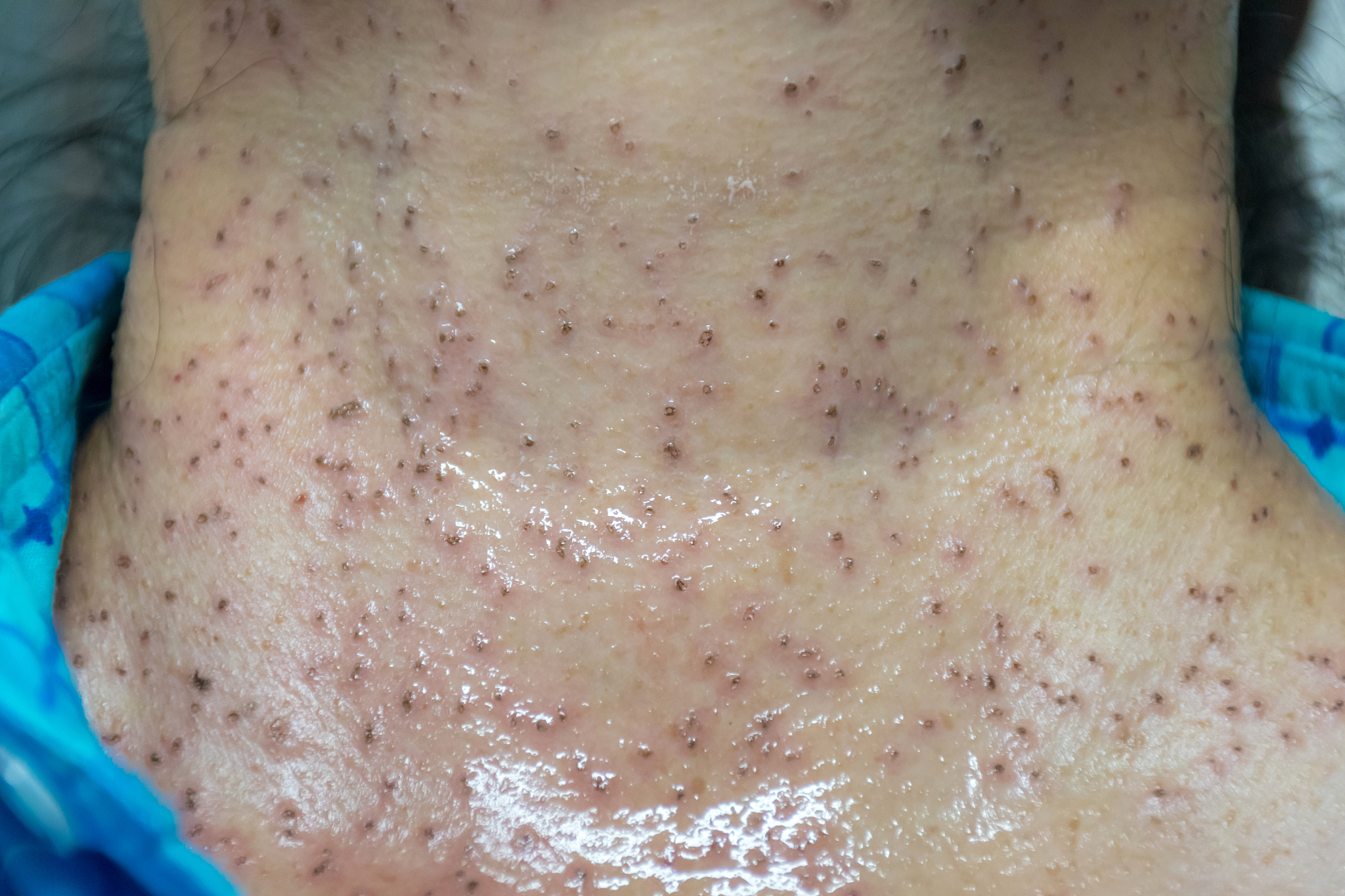 disease skin laser medical and treat for beauty