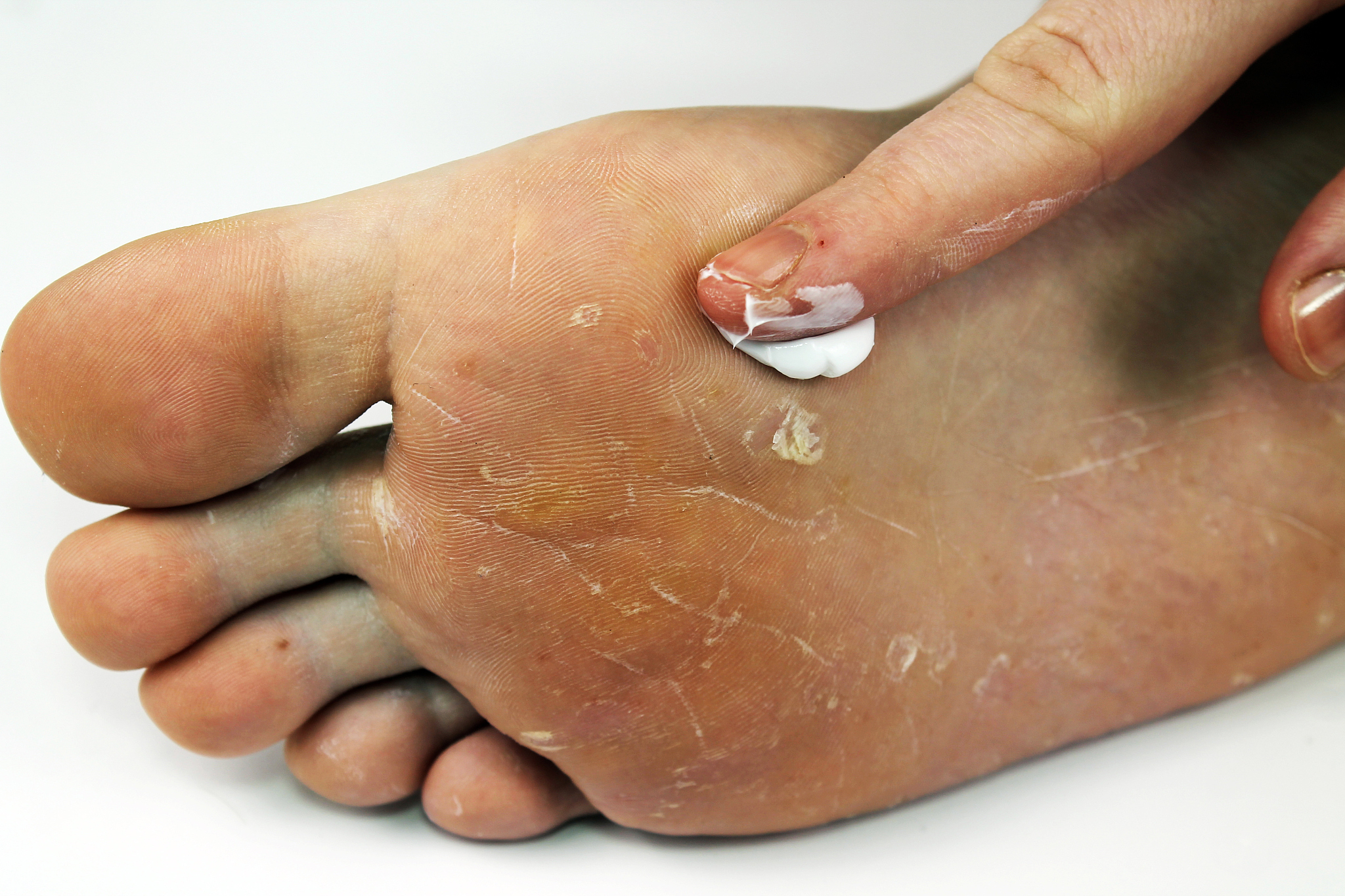 脚臭可以喷酒精吗