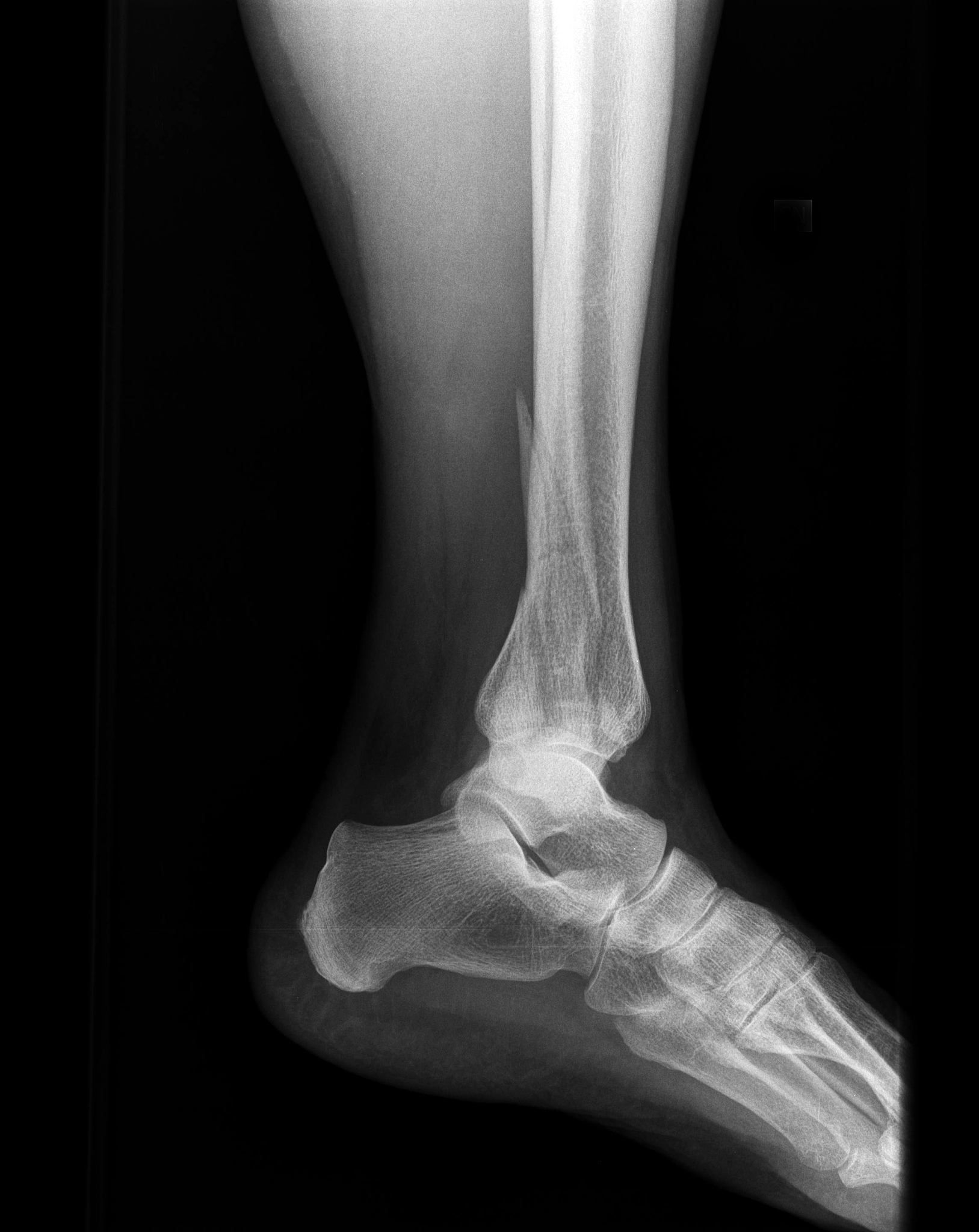 踝关节脱位X线表现