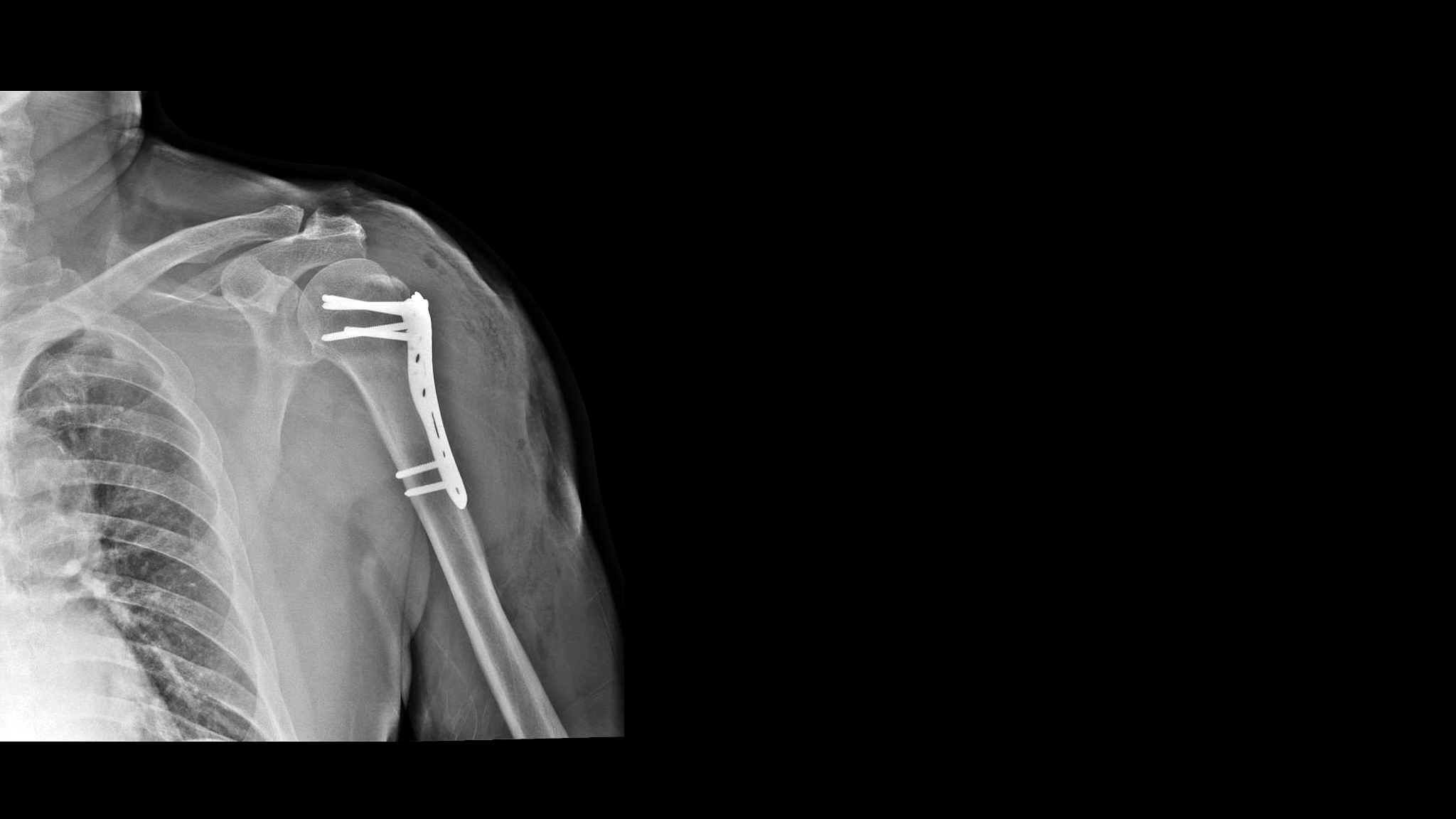 肩周炎什么引起的？需要怎么有效治疗？