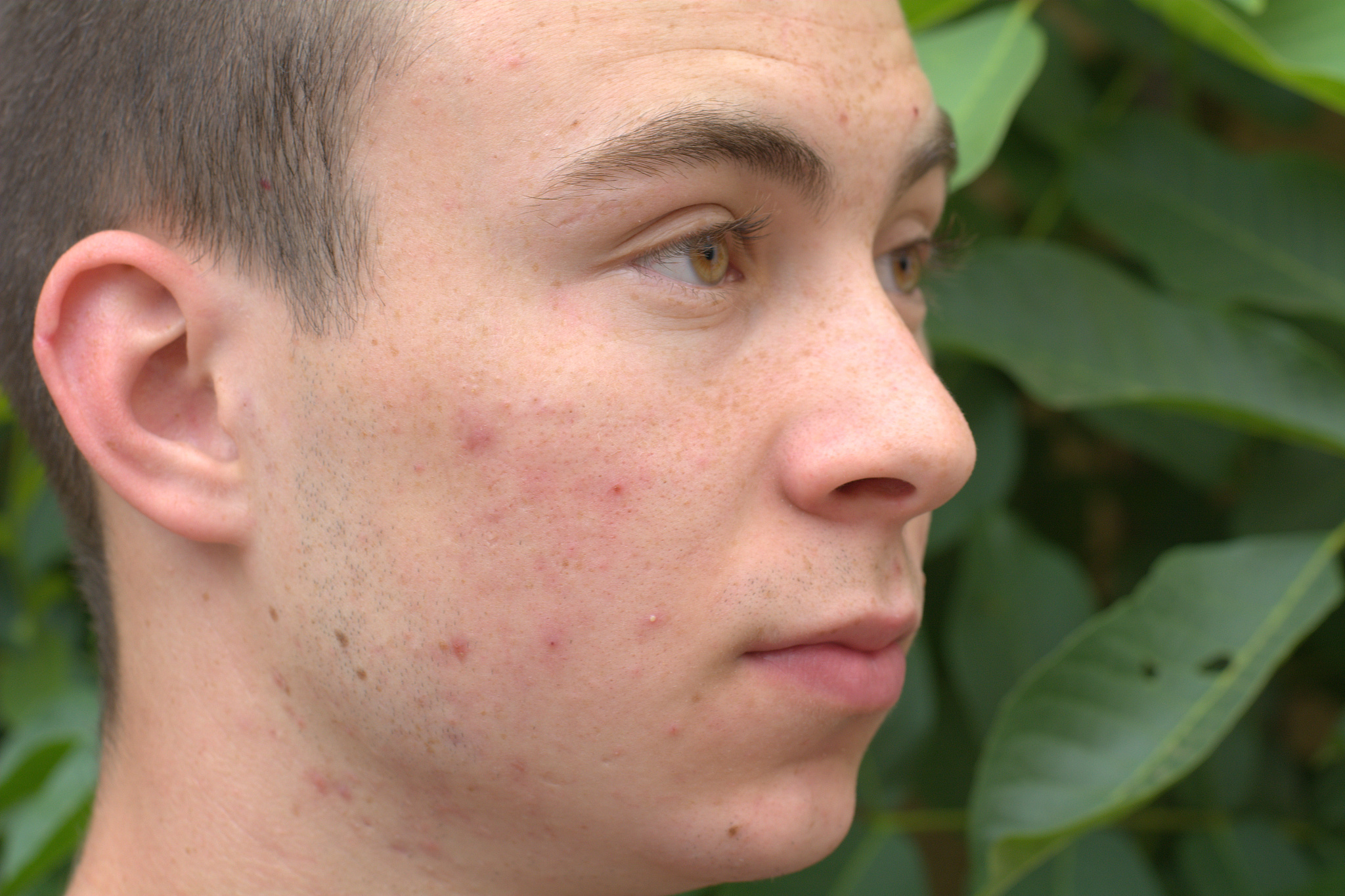 teen boy with acne on his face