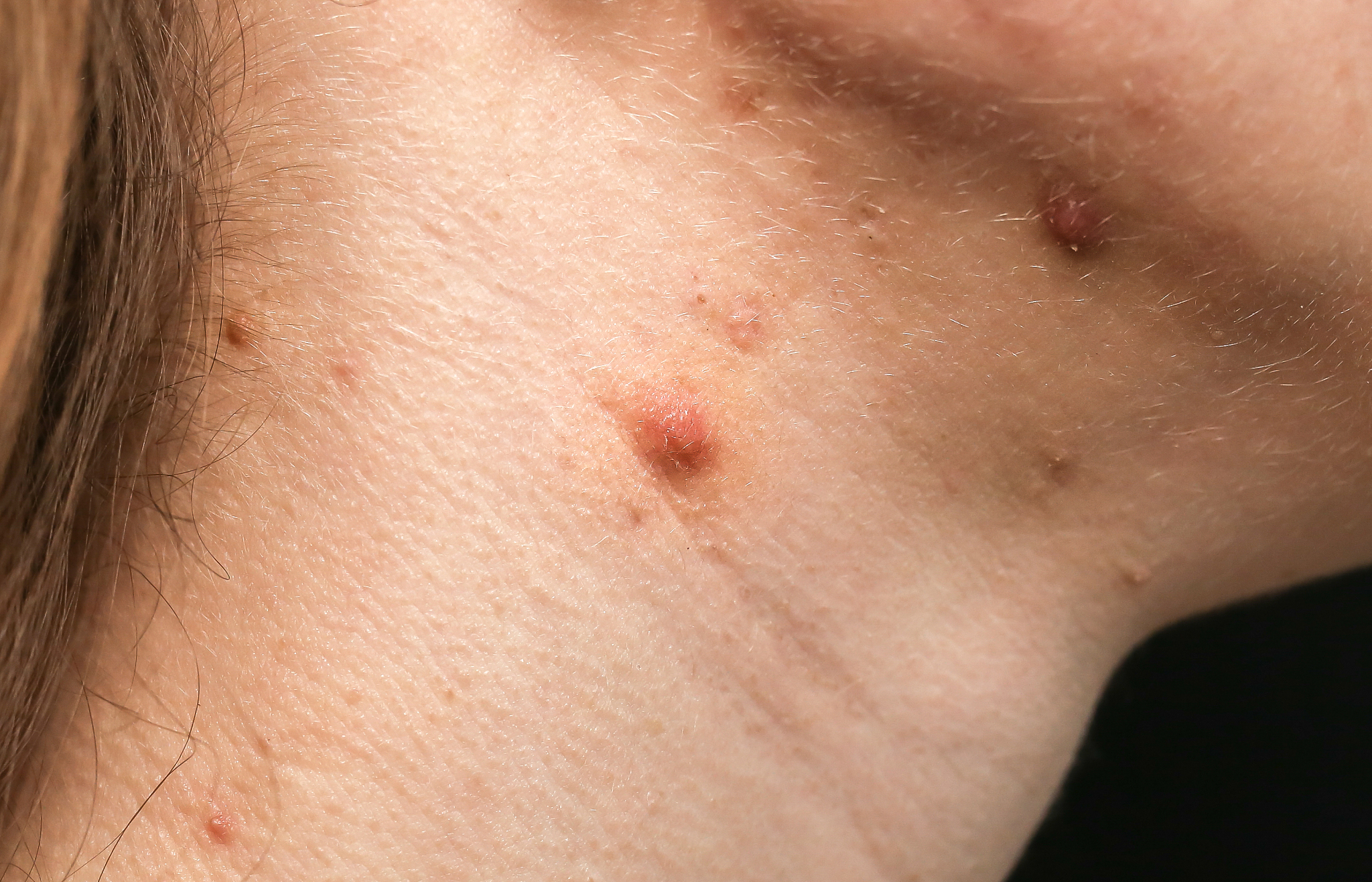 scars and wounds on the neck after acne. woman's oily skin with 