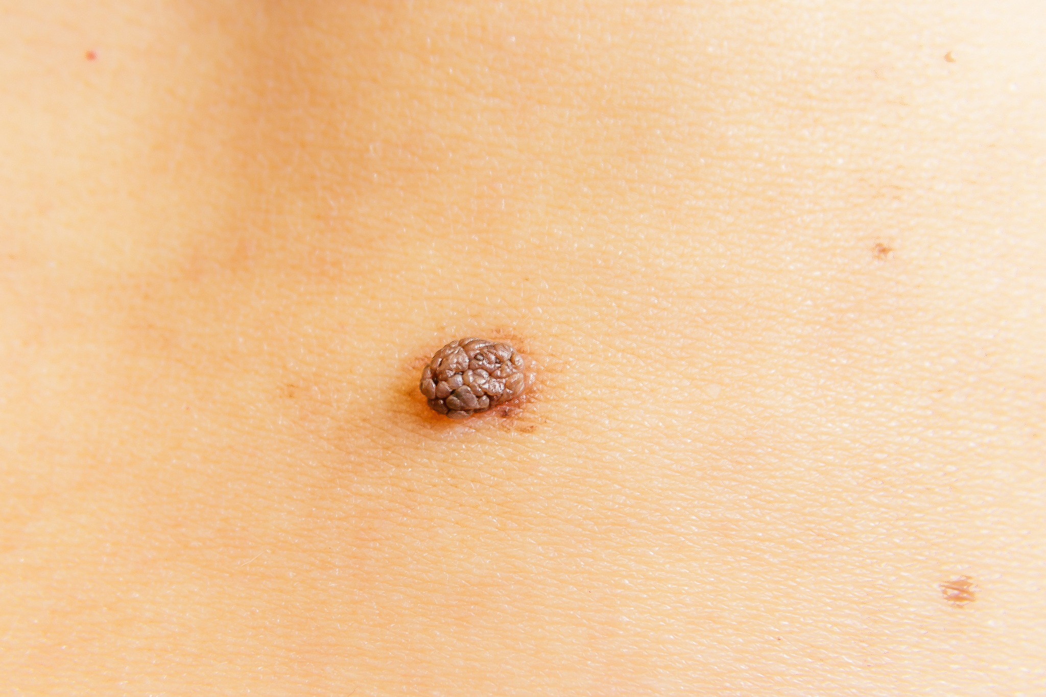 a large brown mole on humans skin