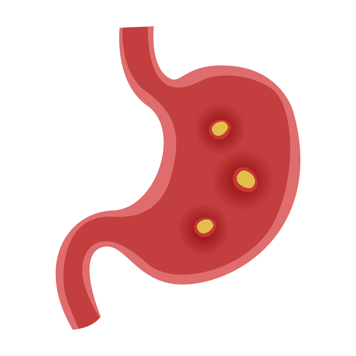 胃病是“吃”出来的？医生提醒：这3类食物要少吃！