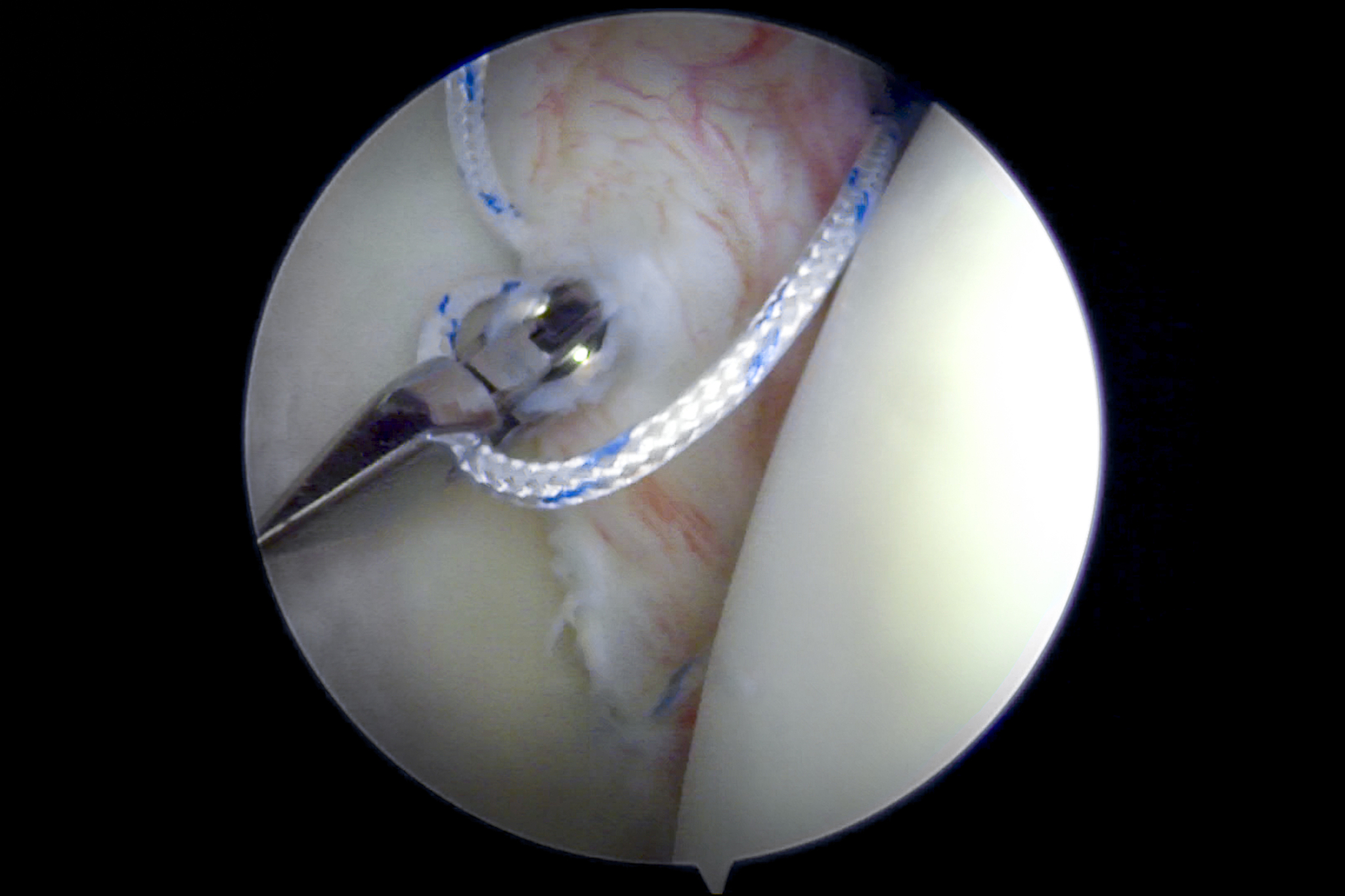 arthroscopic repair of bankart lesion (due to dislocations) of s