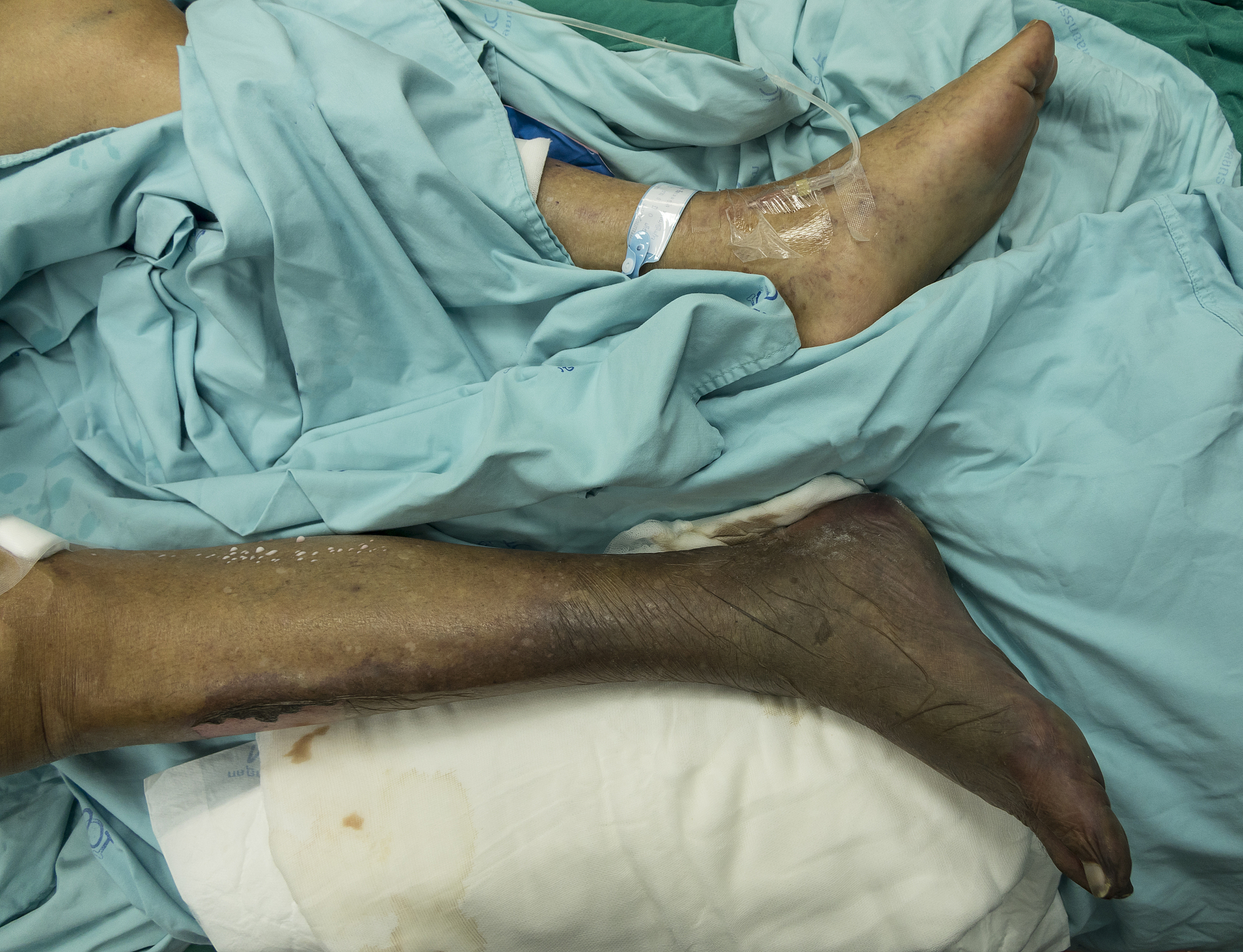 糖尿病足的科普解说方式用于新媒体传播