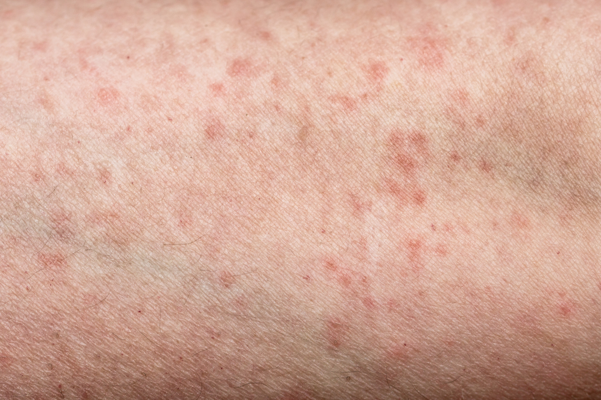 发烧后起疹子怎么办？原因、治疗和预防