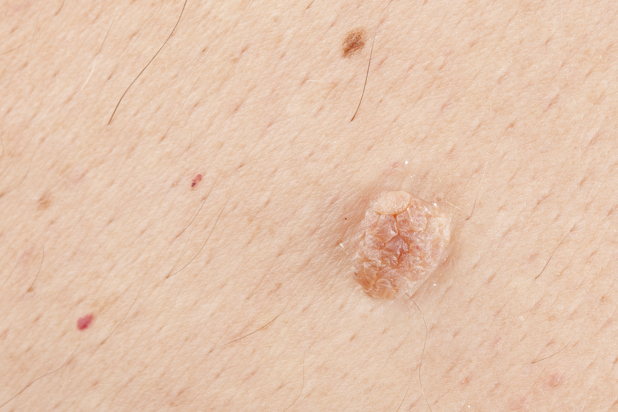 skin wart