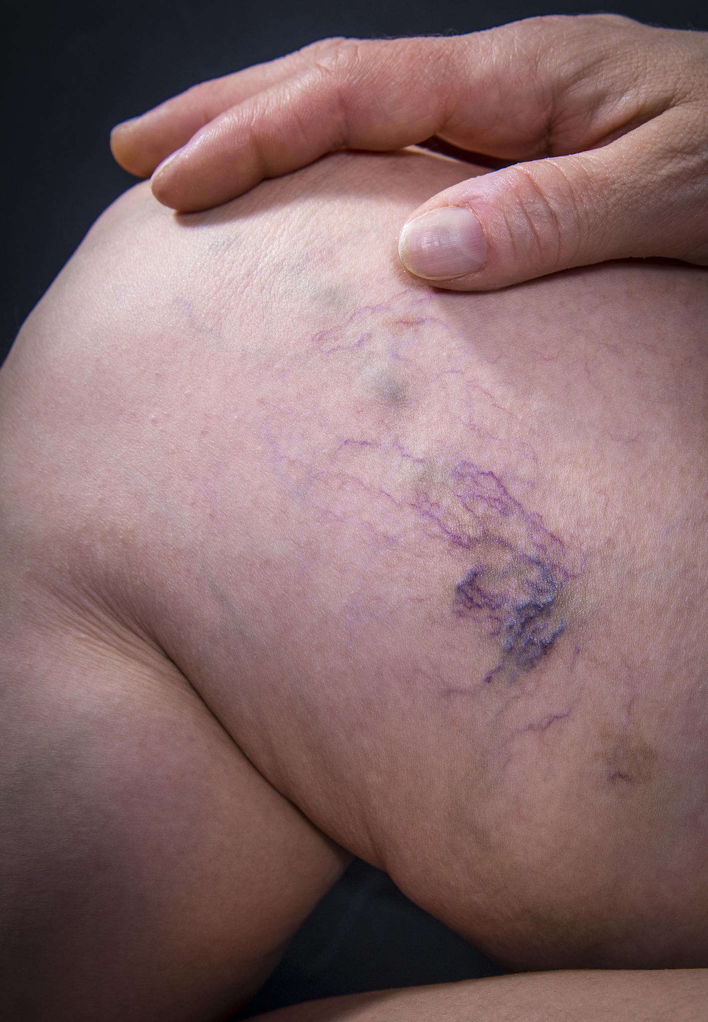 varicose veins