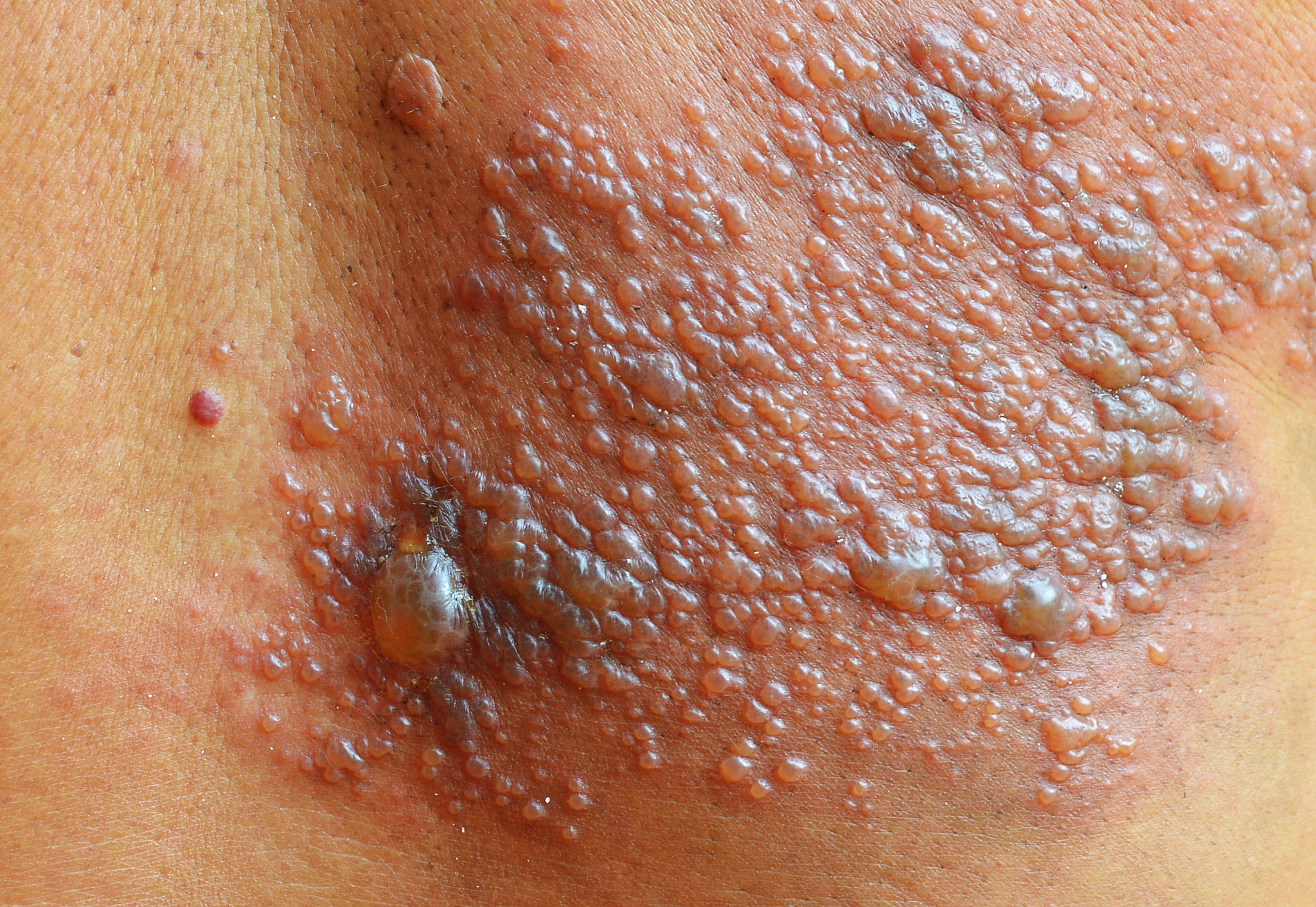 herpes zoster skin.