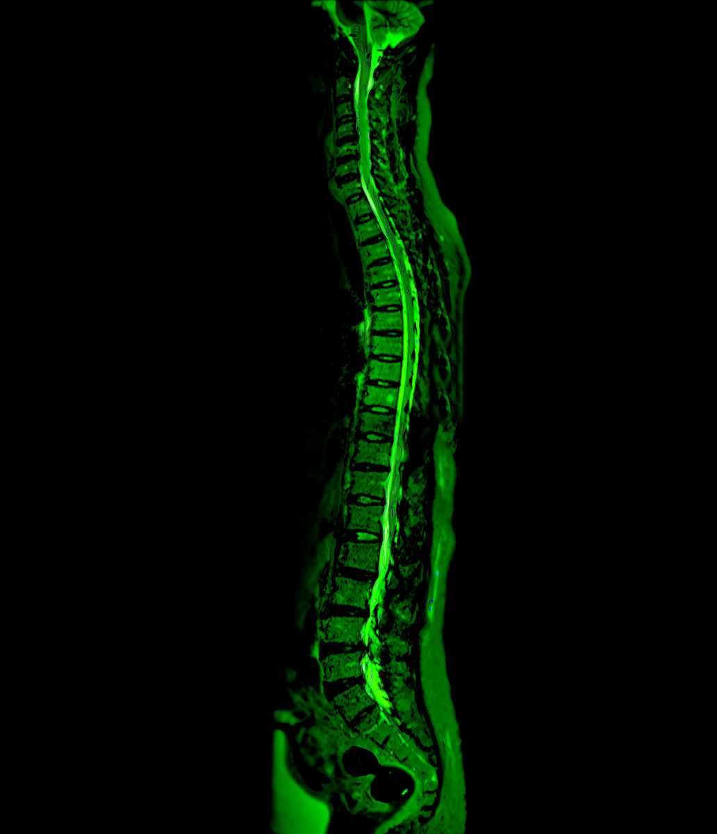 彩超检查中结节的边界欠清和边界不清有什么不同？