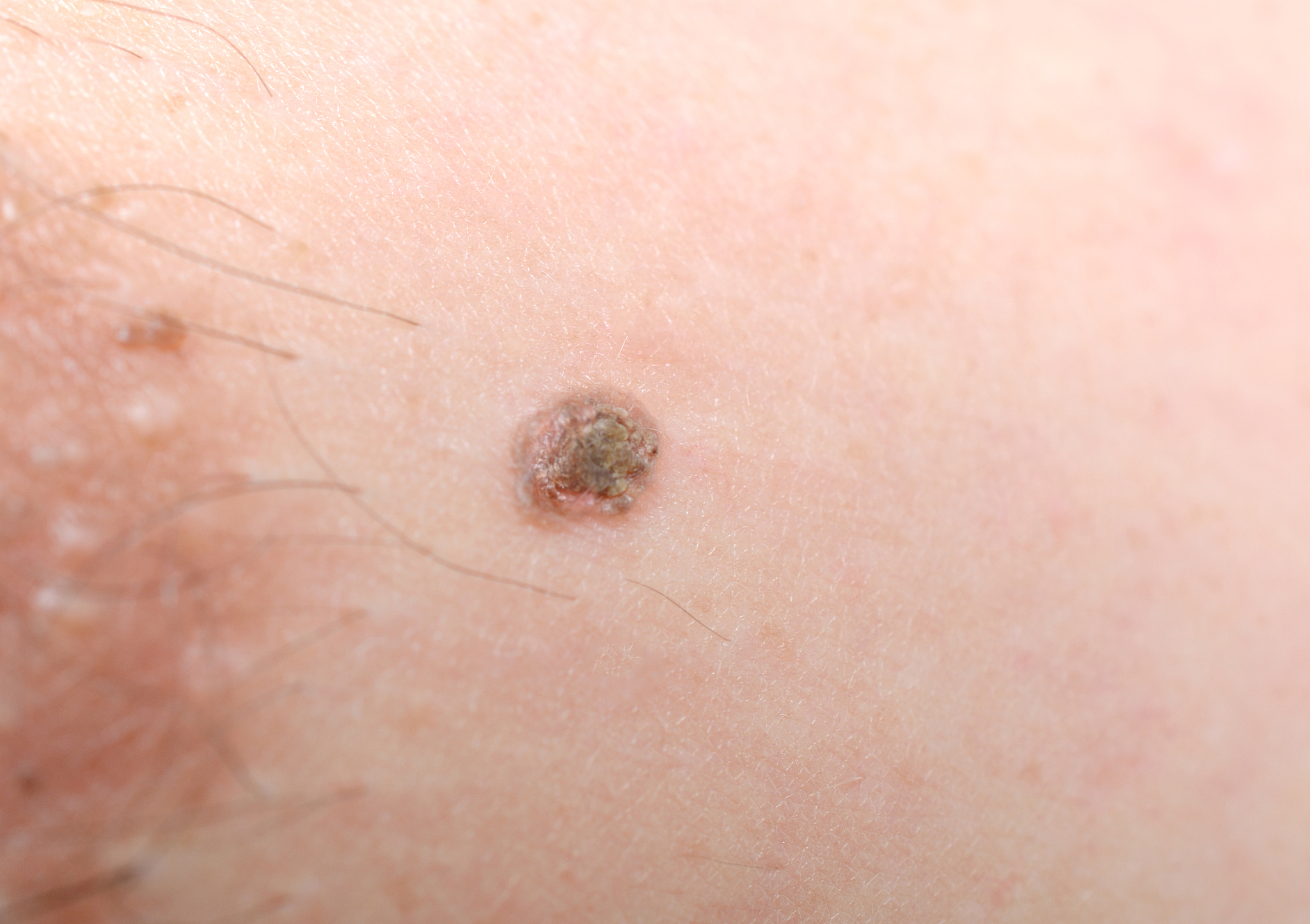 CDK46或CDK2抑制剂是什么