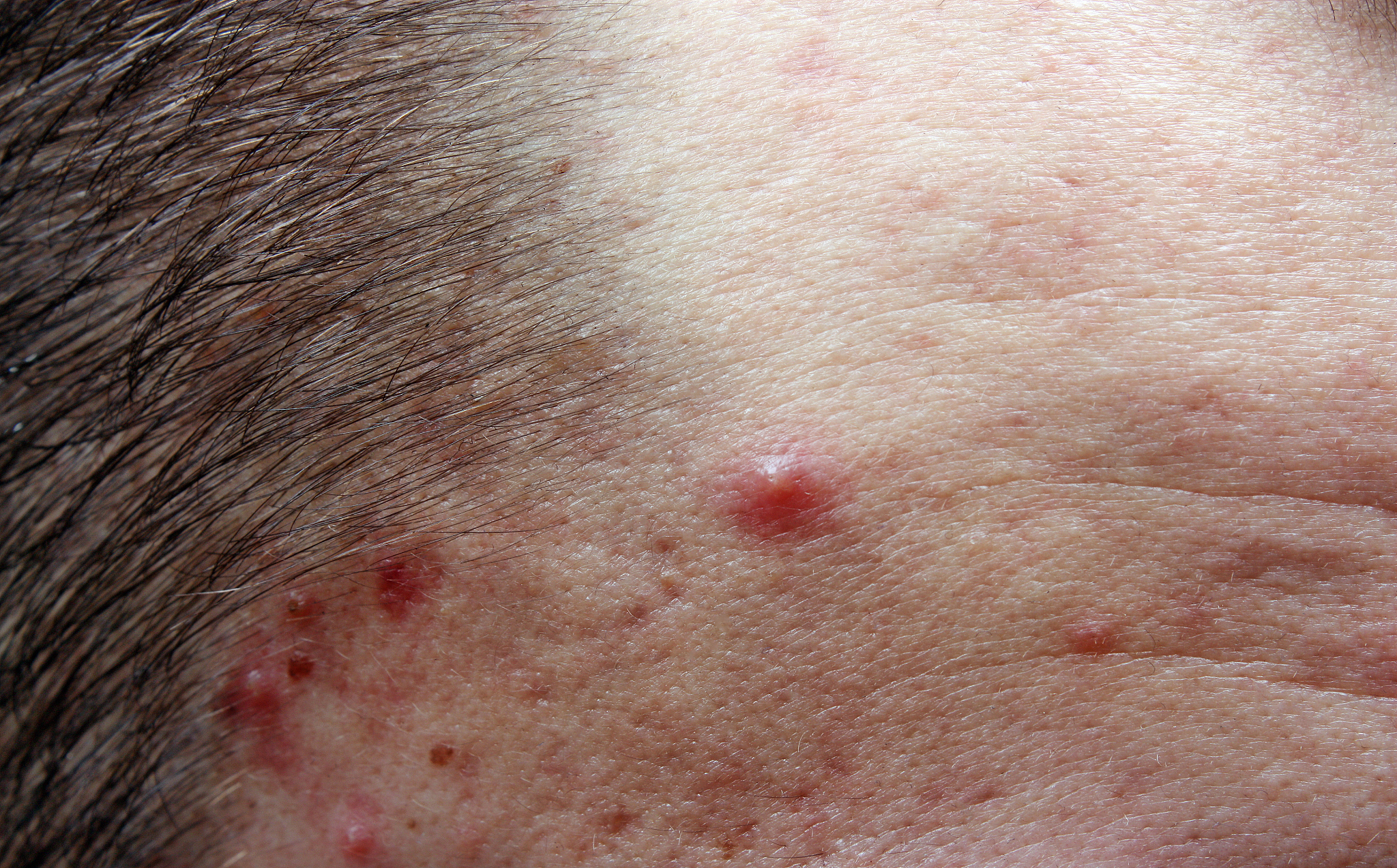 acne pimples on the face